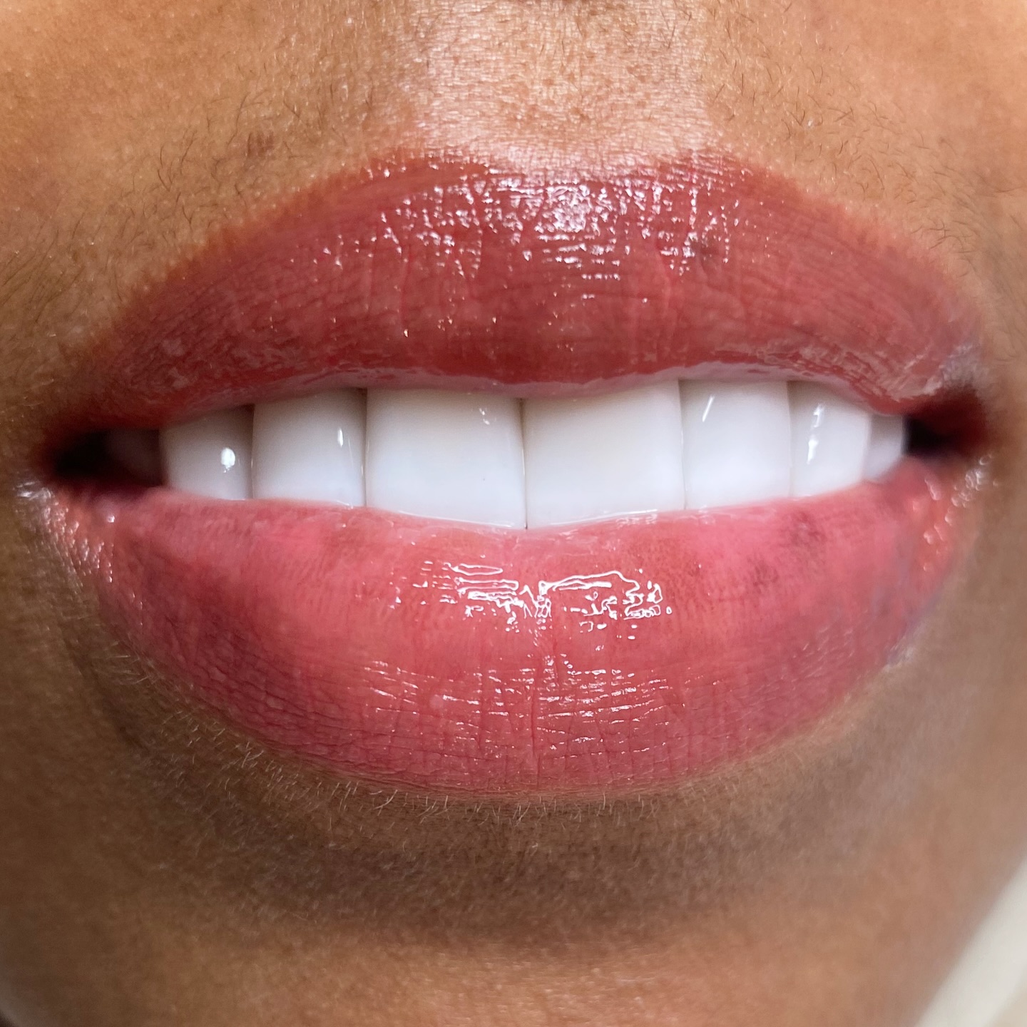 Healed lips after dark lip neutralisation!
Dark Lip Neutralisation | ยฃ250 | SE18
๐คUndo the dark tones and brighten your lips with this semi permanent makeup treatment.
๐คMultiple sessions required for optimal results.
๐คThis treatment can last 3 years +
Book online at iabrows.com/bookings - link in bio ๐
๐ฒSPREAD THE COST WITH CLEARPAY
#darklipneutralization #darklipneutralisation
#darklipneutralisationtraining