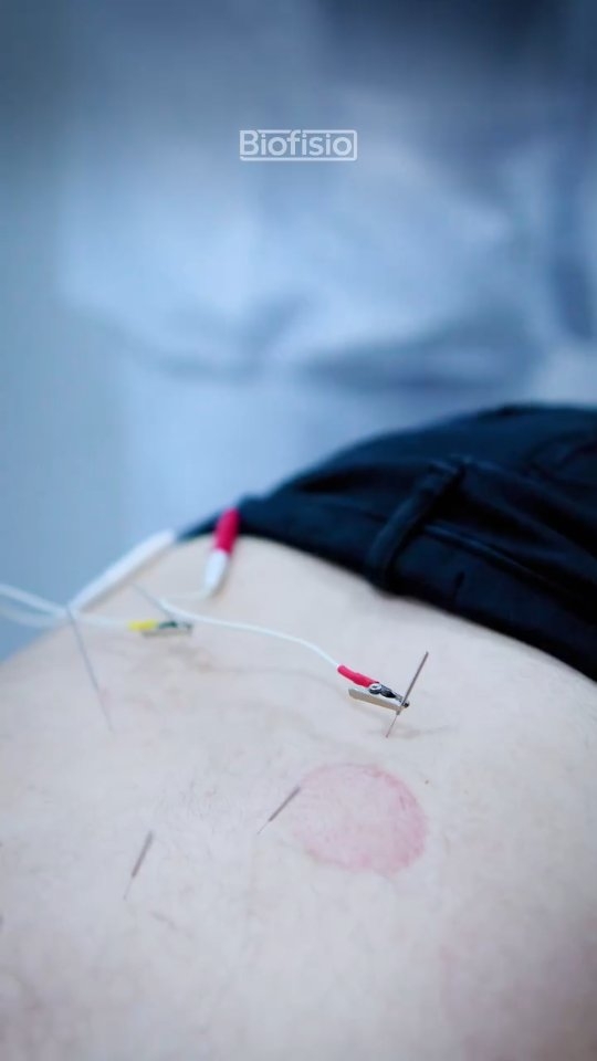 Eletroacupuntura une tradição com tecnologia.
Esta técnica além reunir os benefícios já presentes na Acupuntura, tem como aliado estímulos elétricos suaves, ideal para quem busca:
- Analgesia profunda: controle de dores agudas e crônicas
- Recuperação muscular: ideal para atletas e pós-lesões
- Equilíbrio neurológico: auxílio em casos de paralisias e dores nervosas.
Tratamento totalmente indolor e seguro.
Agende sua avaliação.
(11) 2468-1675
biofisio.com.br
Avenida Esperança, 237
Centro - Guarulhos - SP
📍 Estacionamento no local. Consulte valores!
#biofisio #clinicaintegrada #fisioterapia #guarulhos