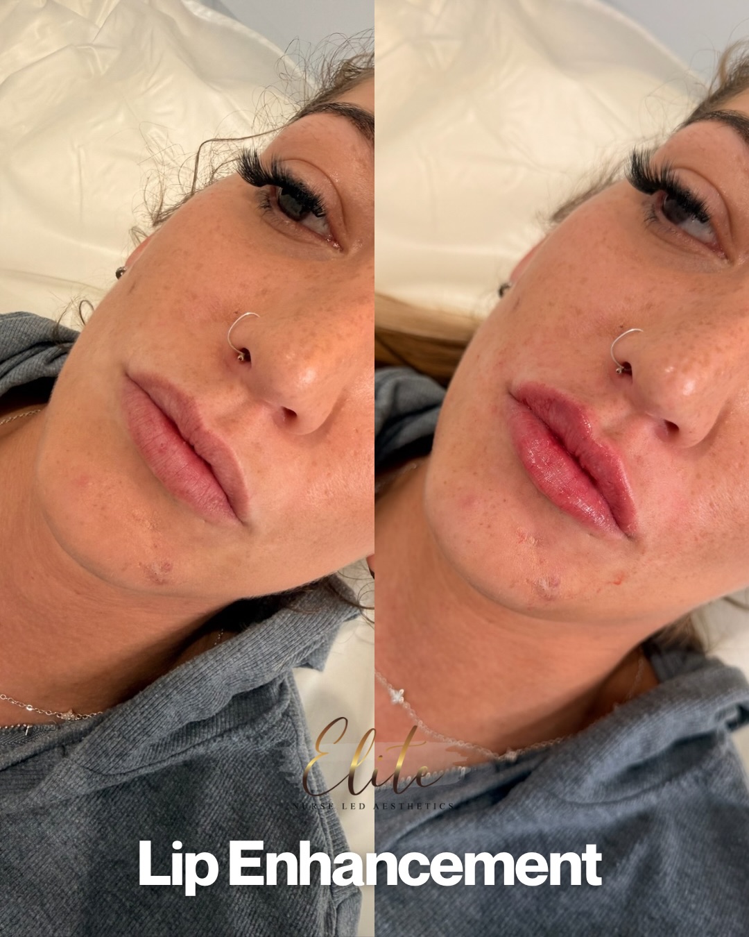 Subtle Lip Enhancement – The “Your Lips But Better” Look
Not everyone wants big, obvious lips… and that’s where subtle lip enhancement comes in.
If you’ve noticed your lips becoming thinner, losing definition, or you just want a little more balance and hydration, this treatment is designed to enhance what you already have – not change your face.
💋 Who is this perfect for?
• Lips that have naturally thinned with age
• Lips that lack definition or shape
• Clients wanting a soft, natural enhancement
• Anyone who wants a hydrated, refreshed look without obvious filler
At Elite Nurse Led Aesthetics, we specialise in natural, balanced results so you still look like you – just a little more refreshed.
📍 Wakefield
📩 Message us to book your consultation or secure your appointment.
#WakefieldAesthetics #SubtleLipEnhancement #NaturalLipFiller #EliteNurseLedAesthetics #LipFillerWakefield