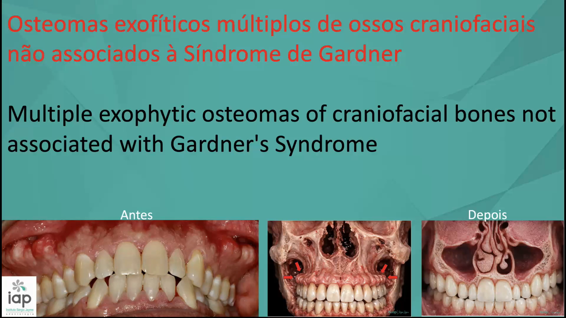 Osteomas exofíticos múltiplos de ossos craniofaciais não associados à Síndrome de Gardner
Multiple exophytic osteomas of craniofacial bones not associated with Gardner's Syndrome
O termo exostose é utilizado para designar lesões que crescem na superfície óssea referindo-se, portanto, a um padrão de crescimento.
Osteomas apresentam características clínicas, radiográficas e histológicas definidas.
Portanto, é importante um diagnóstico preciso, diferenciando osteomas exofíticos,
osteocondromas, hematomas subperiostais organizados, fibroma ossificante maduro que
causou expansão da lâmina cortical e osteossarcomas ou condrossarcomas periosteais.
Exostoses são crescimentos ósseo-benignos no esqueleto facial, que ocorrem ao longo da região vestíbulo maxilar e mandibular e localizadas mais frequentemente na
região de pré-molares e molares.
No exame clínico notou-se protuberâncias múltiplas ósseas e ficaram evidentes na região vestibular em ambos os lados. No exame radiográfico foram detectadas imagens radiopacas,
As descobertas orais foram sugestivas de diagnóstico de Síndrome de Gardner, devido à propensão para tumores intestinais, foi considerado prudente pesquisar esta condição, e o paciente foi, portanto, encaminhado para a realização de endoscopia gastrintestinal e exame de colonoscopia, esses foram considerados normais, sem pólipos detectados.
A Síndrome de Gardner consiste em polipose múltipla do intestino grosso, osteomas dos ossos, incluindo os ossos longos, o crânio e a mandíbula, múltiplos cistos epidérmicos
ou sebáceos cutâneos, particularmente no couro cabeludo e região dorsal, ocorrência ocasional de tumores dermoides e dentes permanentes e supranumerários inclusos.
Esse caso foi executado no IAP-Sérgio Jayme
Bibliografia:
Pynn BR, Kurys-Kos NS, Walker DA, Mayhall JT. Tori mandibularis:
a case report and review of literature. J Can Dent Assoc 1995; 61
(12): 1057-9.
Czuszak CA, Tolson GE 4th; Kudryk VL, Hanson BS, Billman MA.
Development of an exostosis following a free gingival graft: case
report. J Periodontol 1996; 67 (3): 250-3.
Shafer WG, Hine MH, Levy BM. Tratado de patologia bucal. 4ª Ed.
Editora Guanabara Koogan; 1987. p. 154-6.
#implante