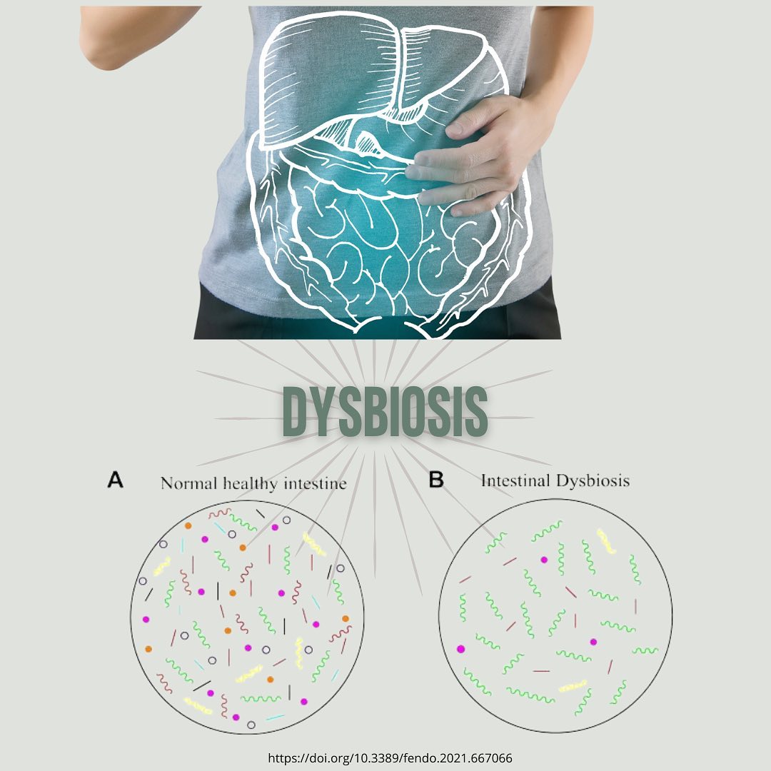 Dysbiosis
Have you ever experienced bloat, constipation, diarrhea, gas, mucous, stomach pain, headaches, brain fog, low energy? I know these symptoms sound awful because they are! The food choices we make, our habitual daily routines, genetics, environment, medications, and stress can all contribute to a disruption in the composition of the microbiome community (beneficial bacteria) in our intestines; this is called dysbiosis. Dysbiosis and an overgrowth of bacteria, fungi, and/or yeast can contribute to many chronic conditions such as IBD, allergies, diabetes, obesity, and colorectal cancer. Studies have shown that the microbiota has a heavy influence on our brain contributing to anxiety, autism, Alzheimer’s, behavior, and cognitive impairment. I can’t stress enough about eating clean with whole foods, learning to read your ingredient labels, and avoiding the western diet that consists of high saturated fats, sugars, and low fiber intake.
It’s best to stop guessing and test identifying the root cause of your intestinal upset. OAT, MRT, mycotoxin, and stool tests can help recognize where to start the healing process for your intestinal health. Biomarkers in these tests reflect metabolic activity of the intestinal bacteria to provide the status of your microbiome. We can spin our wheels trying many different supplements, probiotics, detoxes, or restrictive diets spending too much money with no resolve. Work with a qualified holistic or functional medicine professional to work on a bio-individual restorative plan to realign your gut health and find balance with your microbiome.
Healthy microbiome = body, mind, and spirit wellness.
Be well!
#healthcoach #holistichealth #healthgoals
#healing #healtheducation #holisticnutrition
#holisticpractitioner #liveyourtruestself #inspiration
#mentalhealth #mentalhealthamerica #resilience
#wellbeing #wellnesscoaching #wellnessjourney
#dysbiosis #microbiomehealth #gutbrainhealth