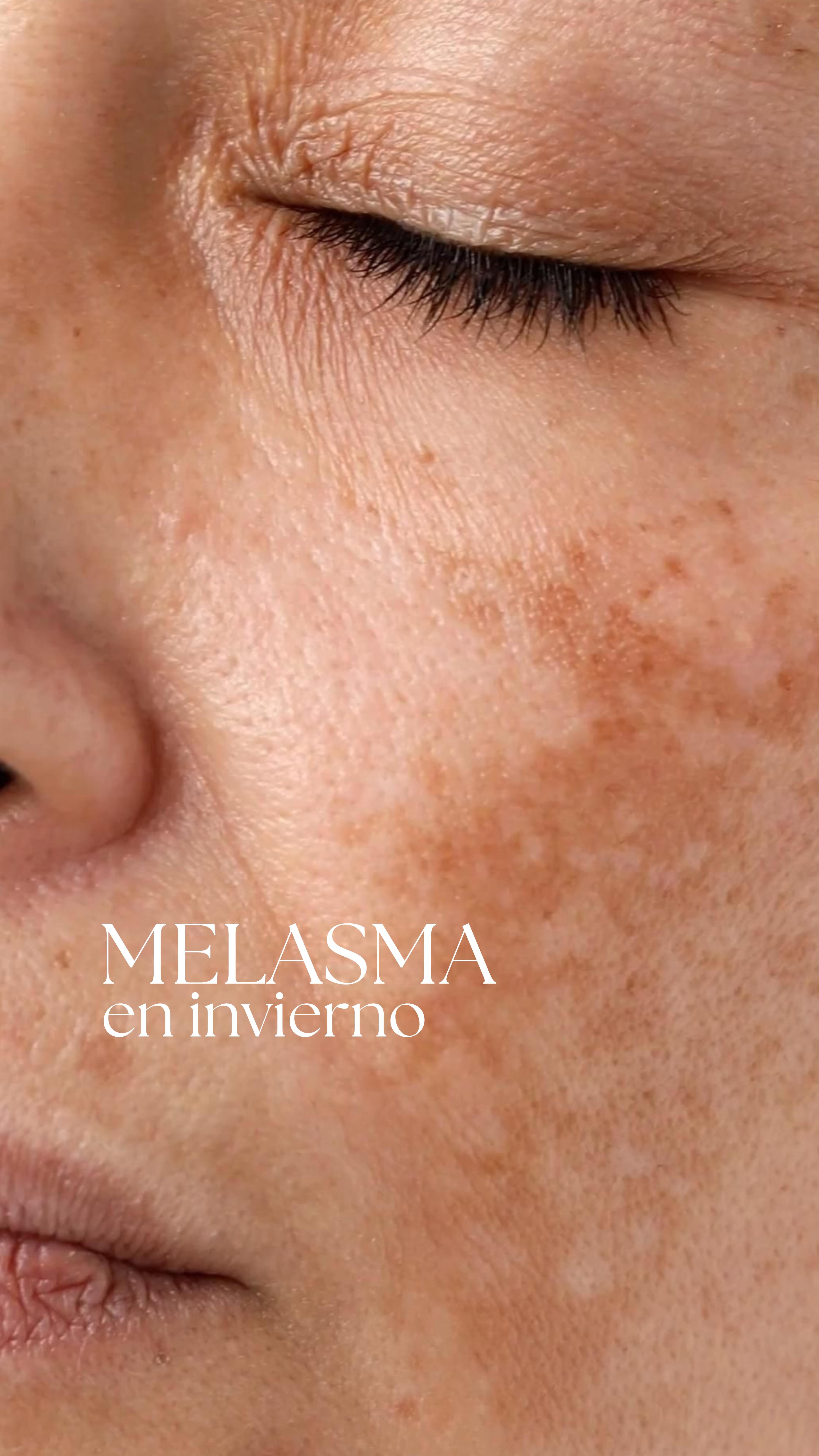 El melasma no es solo una mancha: es una alteración pigmentaria crónica en la que intervienen melanocitos hiperactivos, inflamación, componente vascular y estímulos hormonales.
Por eso muchas veces no desaparece en invierno y por eso también requiere un tratamiento médico individualizado.