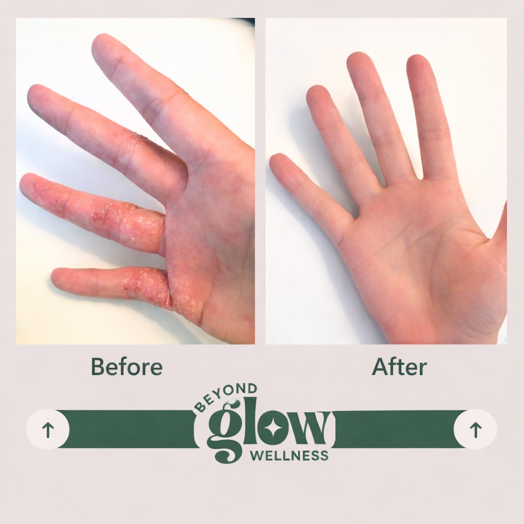 How I cleared my eczema skin flare from the inside out‼️
Instead of suppressing symptoms, I treated this through a Traditional Chinese Medicine and naturopathic lens, addressing the internal drivers behind the skin.
From a TCM perspective, this was a pattern of internal Heat, Dampness, and Blood imbalance expressing through the skin.
👉 Acupuncture was a key part of this process. It helped clear internal heat and inflammation, regulate my immune response, calm my nervous system, and support real skin healing rather than just surface-level relief.
👉 I also used Chinese herbal medicine alongside targeted naturopathic support. This combination helped clear heat and dampness more deeply, support liver detoxification pathways, rebalance the gut and microbiome, and reduce the systemic inflammation driving the flare.
👉 Celery juice each morning became a simple but powerful addition. It acted as gentle liver and digestive support, helping reduce inflammatory load, support gut function, and improve digestion and nutrient absorption for skin repair.
I also ran a microbiome test, which gave me deeper insight into gut imbalances and inflammatory triggers so I could take a more precise approach rather than guessing🔬
When you combine acupuncture, Chinese herbal medicine, and gut-focused naturopathic care, the skin has the environment it needs to heal.
This is the difference between managing symptoms and addressing the root cause 🙌
📍Book in for your free discovery call today to discuss whether Traditional Chinese Medicine and naturopathy may be the missing piece in clearing your skin.
#TCM #TraditionalChineseMedicine #acupuncture #chineseherbalmedicine #holisticskinhealth