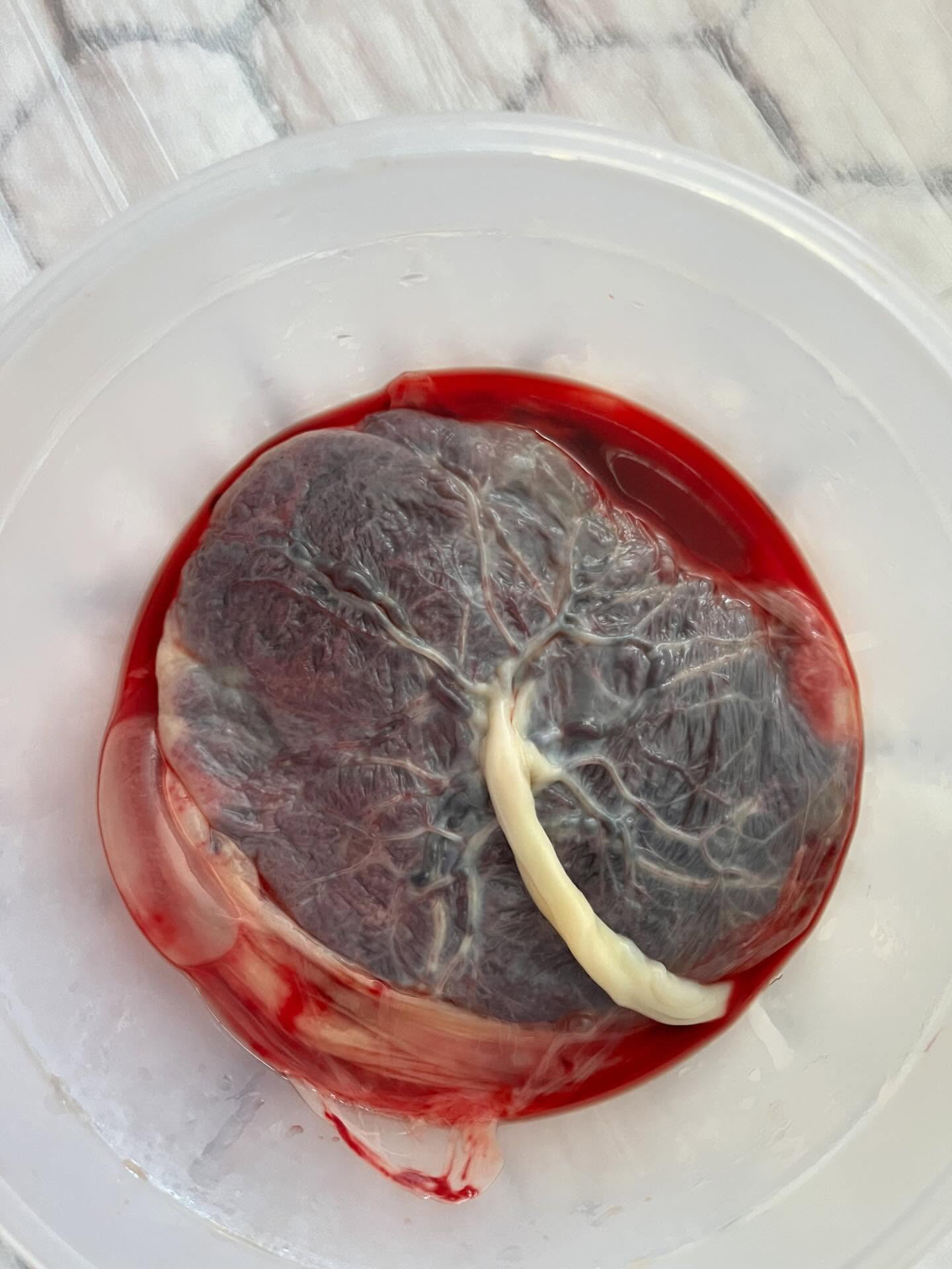 The incredible placenta!
If you’re pregnant have you thought about what you might do with yours? As part of my birth support I help people consider what’s right for them, some people prefer not to look at their placenta and have it disposed of, that’s totally valid if that’s you. But for many women it feels important to honour their placenta or to receive its health benefits.
For some women and families burial and planting a tree above it is a sacred and important thing to do. For others, they want to consume their placenta to get all of its powerful nutrients to support them through birth recovery and postpartum. There are different ways to consume a placenta- one of my colleagues @tortiedoula encapsulates them. Otherwise, after birth while mamas are bonding with their babe I can prepare their placenta into little chunks for the freezer to have a smoothie a day for the next few weeks. Smoothies are such a fab way to get all the health benefits whilst it tastes delicious.
Another way to honour the placenta is to make some prints of it, that’s also something I have helped many families with.
I wonder, those of you who have birthed did you do anything with your placenta? I’d love to hear.
———————————————————
❤️ Like this post
✏️Write your comments
🤰🏽Tag your friends
Follow me for more - @daniella.dean.doula
#bristoldoula #placenta #birth #placentasmoothie #postpartumoptions