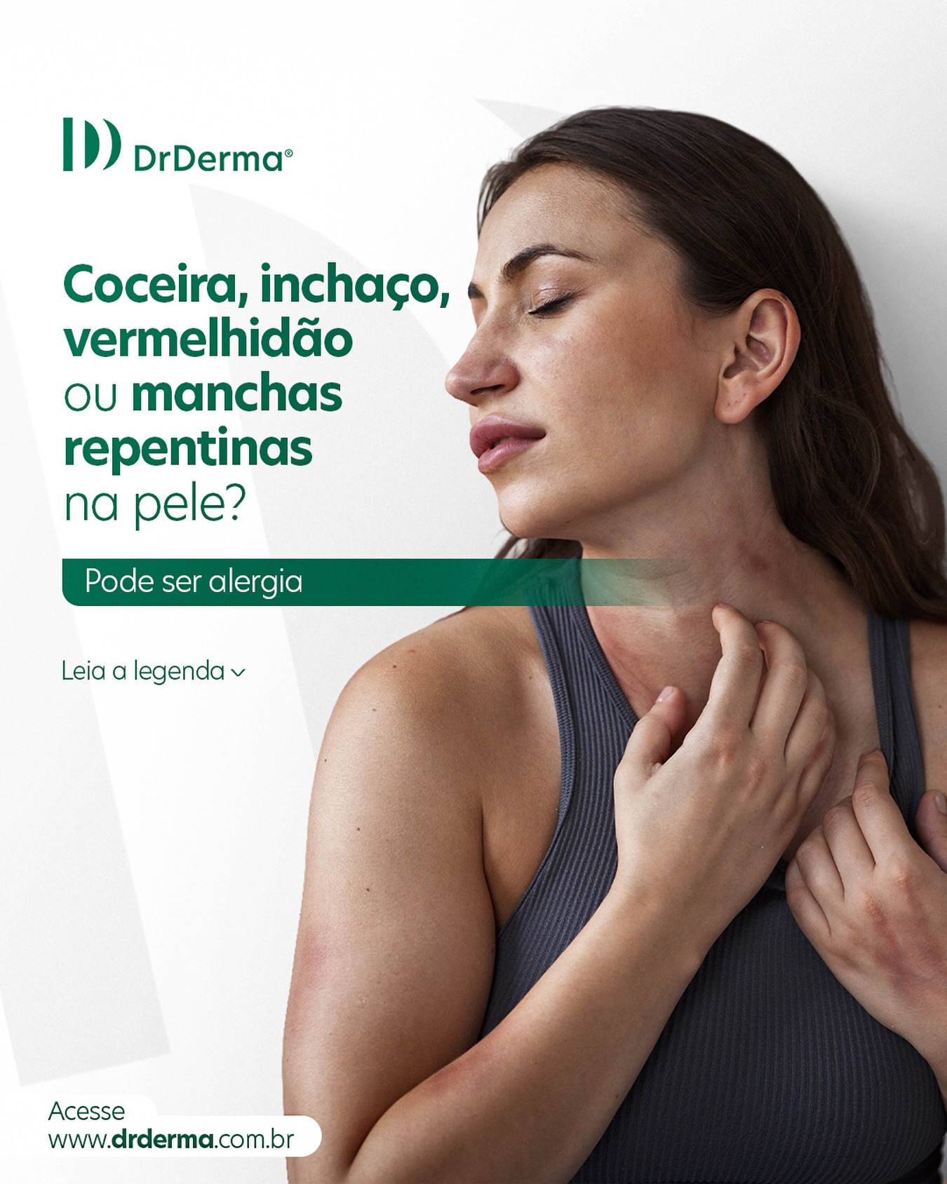 Alergias dermatológicas podem surgir do nada: um novo cosmético, um tecido diferente ou até algo na alimentação. Identificar os sinais precocemente é o primeiro passo para o alívio.
Fique atento a estes 4 sinais comuns:
➡️ Vermelhidão persistente: Áreas avermelhadas que não desaparecem em poucas horas.
➡️ Coceira intensa: A sensação de prurido que incomoda a rotina e o sono.
➡️ Pequenas bolinhas ou descamação: Alterações na textura da pele que podem indicar inflamação.
➡️ Inchaço local: Quando a área afetada parece mais “altinha” ou quente ao toque. Muitas vezes, a solução parece ser um “creminho de farmácia”, mas o uso inadequado de pomadas pode mascarar problemas graves ou piorar a reação.
Acesso o site da DrDerma pelo link da BIO e agende uma consulta com um dermatologista especialista. www.drderma.com.br #dermatologistaonline