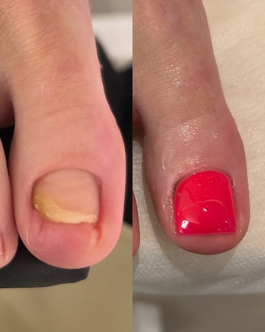 Our toenail reconstruction treatment rebuilds damaged or missing toenails using a specialist gel to create a natural-looking nail. We’re proud to be one of the only clinics in London offering this treatment — and for many clients, it’s truly life-changing.
#TheGlowBarLDN #ToenailReconstruction #LondonBeautyClinic #FootCareLondon #HealthyNails