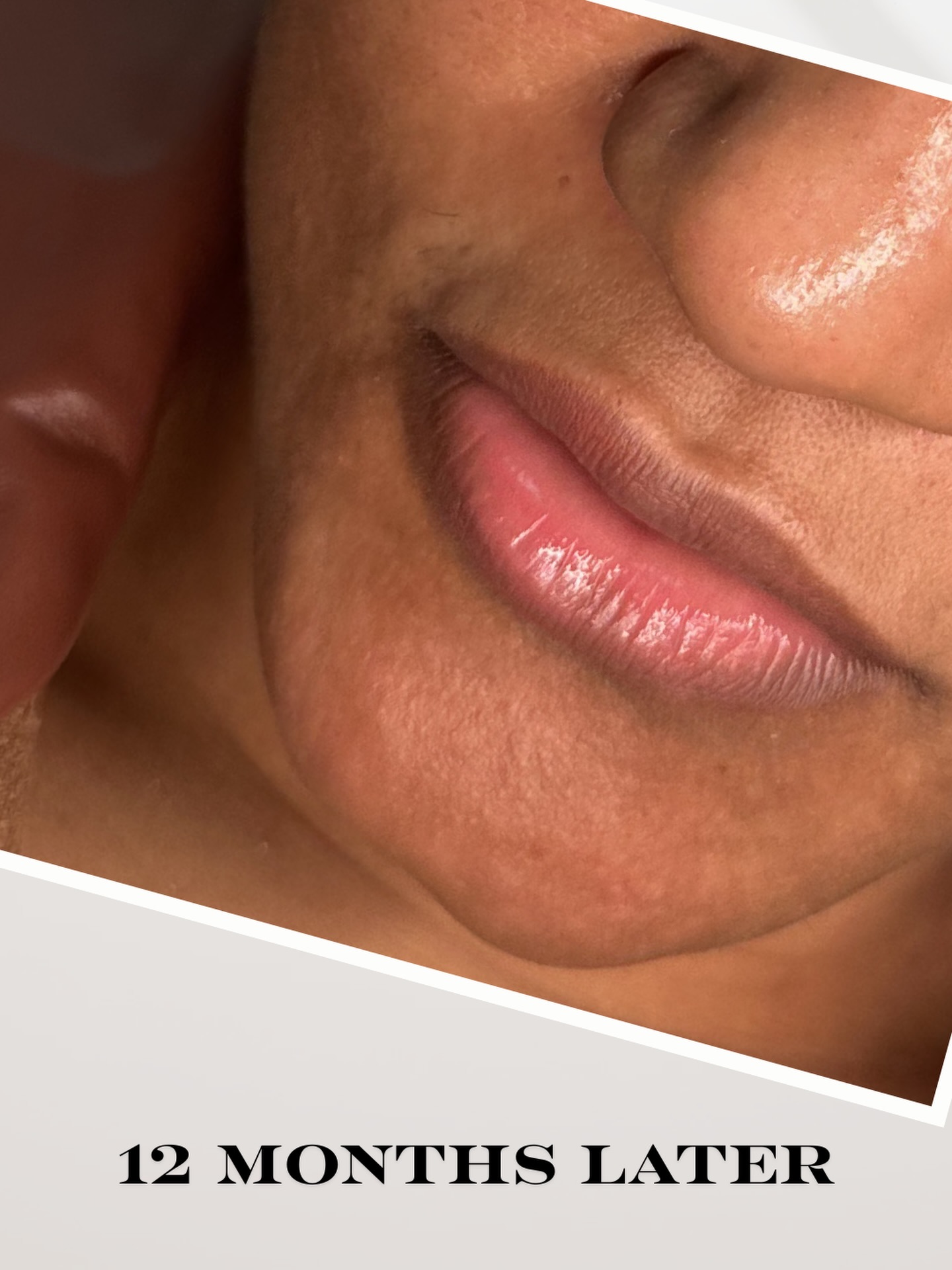 12 months later… 💋
Natural, balanced, and still looking effortlessly good ✨
Because when it’s done right, your results age gracefully 💄
📲 Time for your annual touch-up—book via our website
📱 Text 914-496-2298