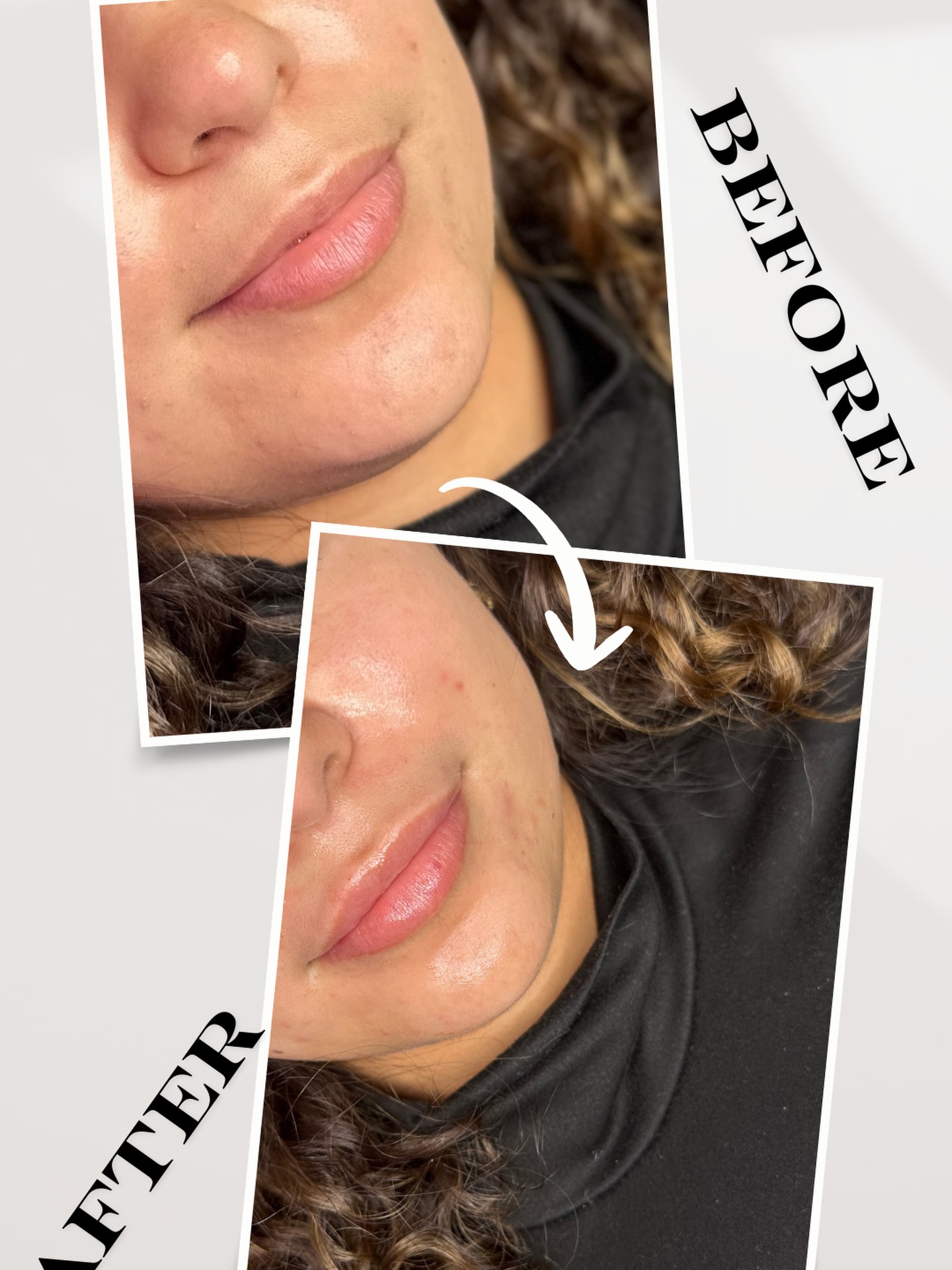 Do you just want a little symmetry? We got you 💋
Enhance your natural beauty with subtle, balanced results—because perfection doesn’t have to look overdone ✨
📲 Book your appointment via our website: www.luxemedicalinc.com
📱 Or text 914-496-2298
Natural. Refined. YOU.