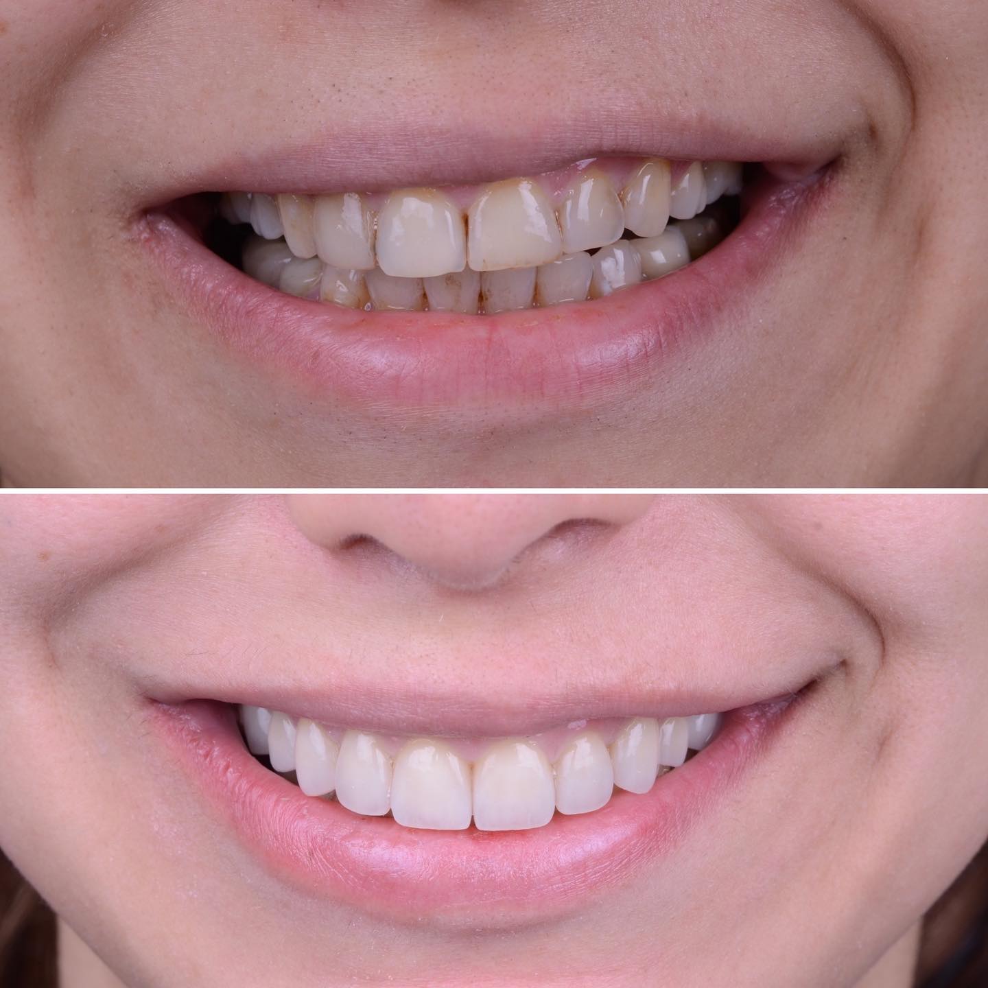 Amazing Smile Transformation which was part of a functional full mouth rehabilitation. Whenever we treat teeth we want to make sure the result also looks esthetically pleasing. The goal here was a super natural fresh look that blends perfectly in with the patients facial characteristics.
If you look closely you can see that the smile was canted and corrected with the new teeth. This has a huge effect on the whole face of the patient.
The case was done for a super special patient - Thank you for your trust! 😊
#abudhabidentist #dentistabudhabi #dubaidentist #dentistdubai #smiledesign #digitalsmiledesign #zahnarzt #dentist #estheticdentistry #veneers #3shape #highenddentistry #digitaldentistry #sboe #biologicaldentistry #predictibledentistry #adent #veneersabudhabi #veneersdubai #fullmouthrehabilitation #biomimeticdentistry #functionaldentistry #ivoclarvivadent #adent