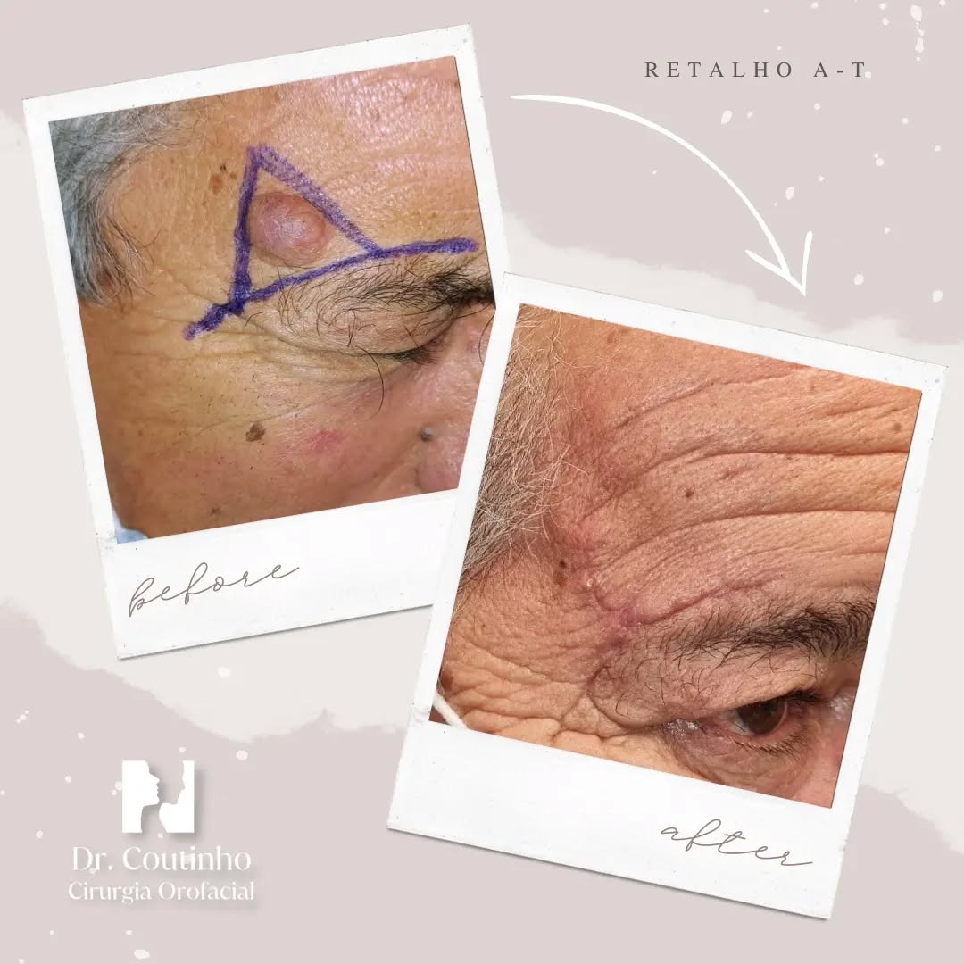 Antes e depois: a precisão e delicadeza na cirurgia de excisão de um tumor facial.
O resultado é natural graças ao uso cuidadoso de um retalho A-T.
Este caso demonstra a importância de respeitar as estruturas faciais únicas de cada paciente. Durante o encerramento, realizamos plastias meticulosas para preservar a simetria e evitar alterações na implantação das estruturas faciais, neste caso a sobrancelha.
Cada passo é feito com o máximo cuidado para garantir não apenas a remoção segura do tumor, mas também para manter a integridade estética do rosto. 🌟
#CirurgiaFacial
#ExcisãoDeTumor
#AntesEDepois
#RetalhoAT