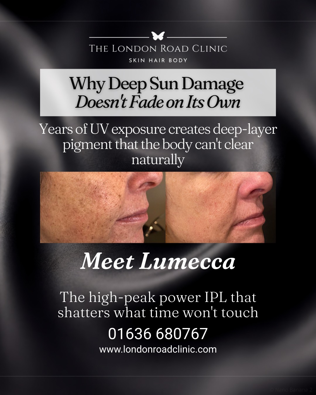 That sun damage you've been hoping would fade? It won't.
Years of UV exposure deposits pigment deep in the skin, below the layers your daily routine can reach. Left alone, those spots and patches of redness don't stay put. They can darken, spread, and become harder to treat over time.
That's where Lumecca comes in.
It's a high-peak power IPL that targets the specific pigments causing uneven tone, age spots, redness and visible veins. It works by finding the melanin (brown) and haemoglobin (red) sitting beneath the surface, and breaking them down so your skin can clear them naturally.
Face. Neck. Chest. Hands. The areas that show your history the most.
Most clients notice visible improvement in as few as three sessions. No downtime drama, no guesswork, just targeted light doing precise work.
Worth knowing:
✔ Visible age spots or "liver" spots
✔ Persistent redness or thread veins
✔ Uneven tone across face, chest or hands
If you ticked even one, it's worth a conversation.
Your consultation is free, friendly and completely no-obligation. We'll assess your skin, talk through what Lumecca can realistically do for you, and build a plan that fits.
Book yours today.
📞 01636 680 767
🌐 www.londonroadclinic.com
📩 hello@londonroadclinic.com
Clinical treatments. Real results.
#Lumecca #InMode #IPLTreatment #SunDamage #Pigmentation #AgeSpots #Rosacea #Redness #ThreadVeins #UnevenSkinTone #SkinDamage #PhotoRejuvenation #IPL #SkinClarity #LumeccaIPL #InModeTechnology #SkinHealth #ClearSkin #ClinicResults #AestheticClinic #DoctorLed #SaveFace #Newark #Nottinghamshire #EastMidlands #LondonRoadClinic