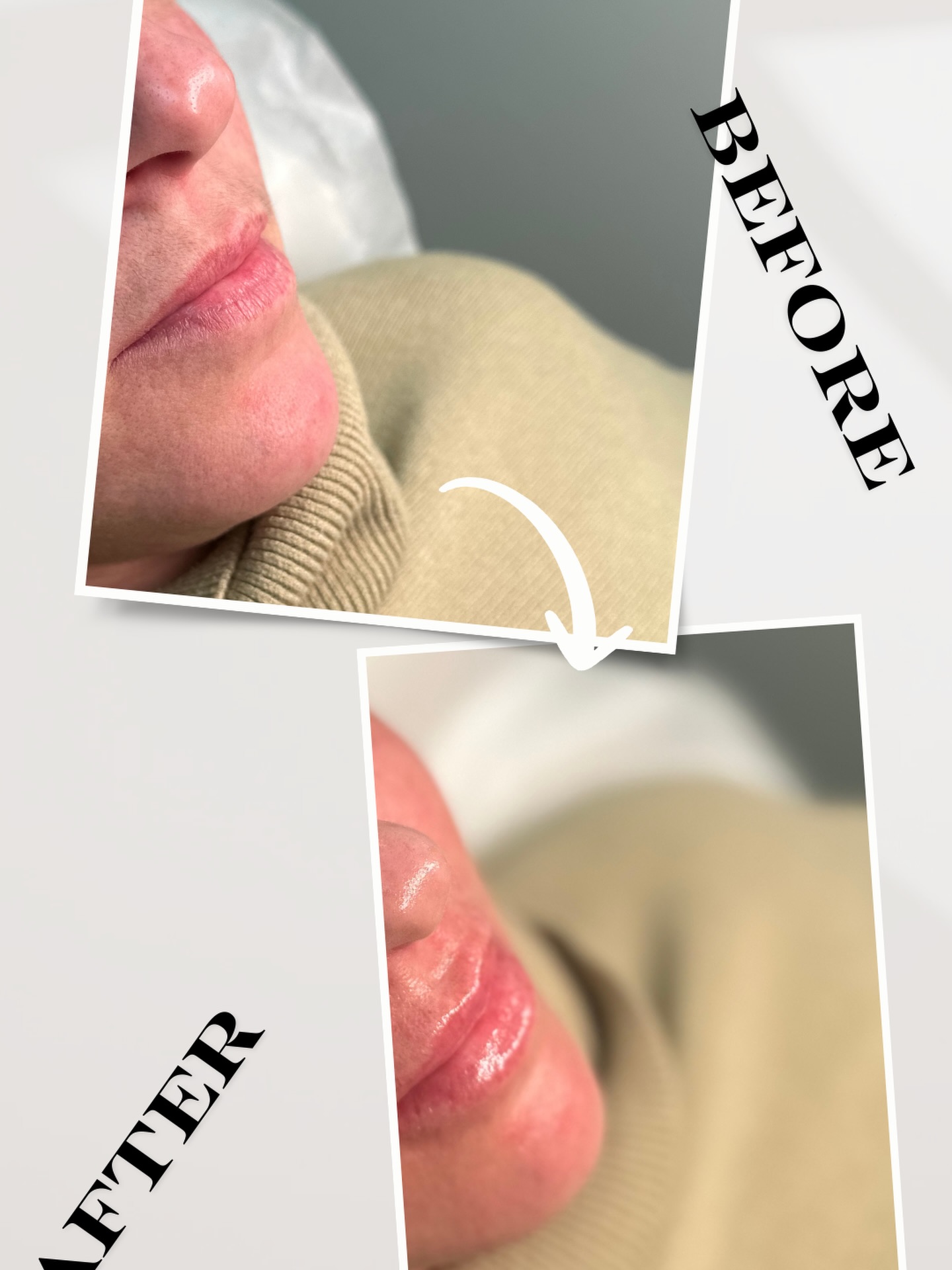 ✨ The “Just Enough” Lip ✨
Not too much—just the perfect balance of
💉 Plump
💉 Volume
💉 Hydration
For lips that look naturally full and effortlessly smooth 💋
📲 Book your appointment online
📱 Text 914-496-2298