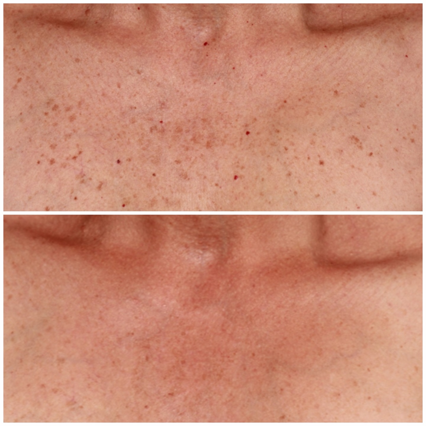 This before + after is after 4 sessions using the Palomar Icon IPL with the IPL Max G and the difference speaks for itself.
IPL (Intense Pulsed Light) works by targeting pigment and vascular irregularities in the skin, helping to visibly reduce:
- Sun damage
- Redness + broken capillaries
- Brown spots + uneven tone
The Max G handpiece is especially effective for chest treatments, where sun exposure often leaves behind stubborn pigmentation and redness. Over a series of treatments, skin appears clearer, brighter, and more even-toned with minimal downtime ✨
For March - Buy 3 IPL treatments, get your 4th FREE (Save $400).
📞 Call 604-943-9399
📧 reception@viewlaser.com