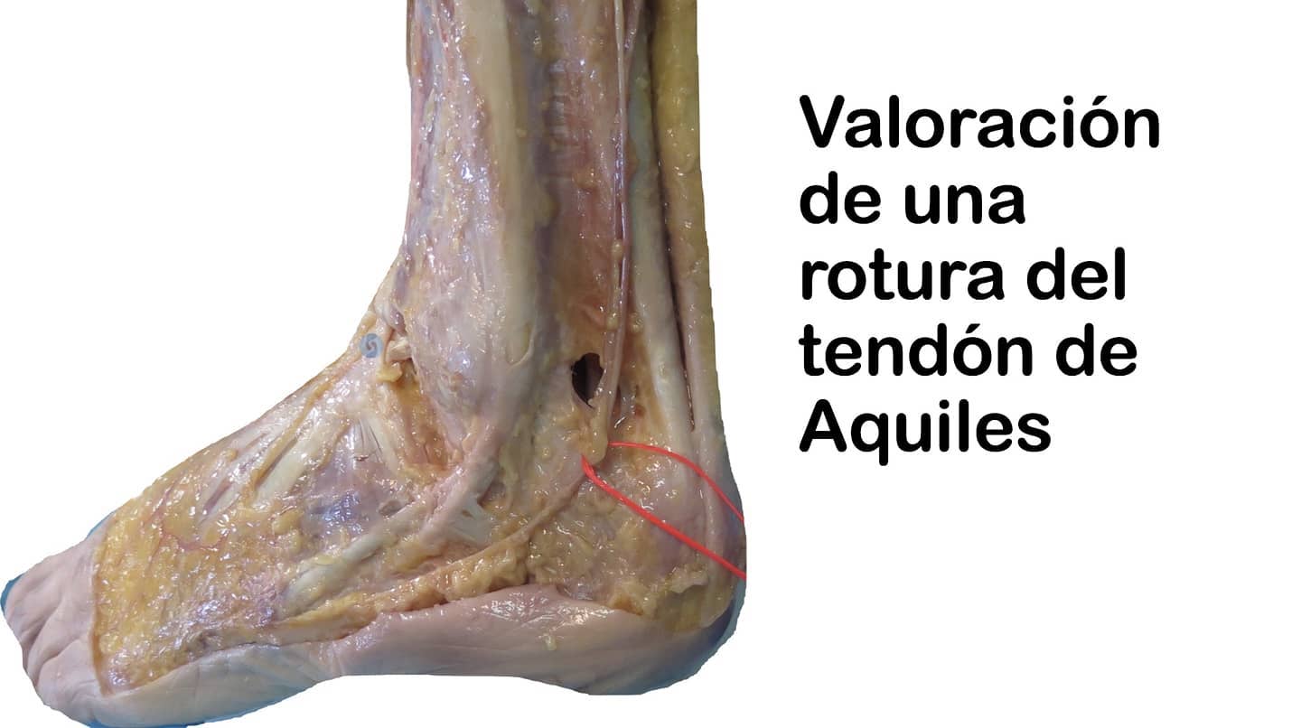 ¿Cómo podemos saber al momento si alguien se ha roto el tendón de Aquiles?
Pues bien, tendremos que fijarnos en que nos explica, seguramente te diga que:
✅Ha notado como si le hubieran dado un golpe por detrás
✅Ha escuchado un fuerte sonido
✅Le duele toda la pantorrilla y detrás del talón
✅Verás que el pie se ha hinchado
✅No podrá caminar ni hacer el gesto de ponerse de puntillas
Pero bien, para acabar de confirmar que se trata de eso, tenemos un test muy sencillo:
✅El test de Thompson
🚩Una vez tengas confirmado lo anterior, te recomiendo enviarla a un traumatologo a que valore el alcance real de la misma.
#fisioterapia #rehabilitación #fisioterapiadeportiva #traumatologia #deporte #salud #tendondeaquiles #ruptura #dolor #thompson