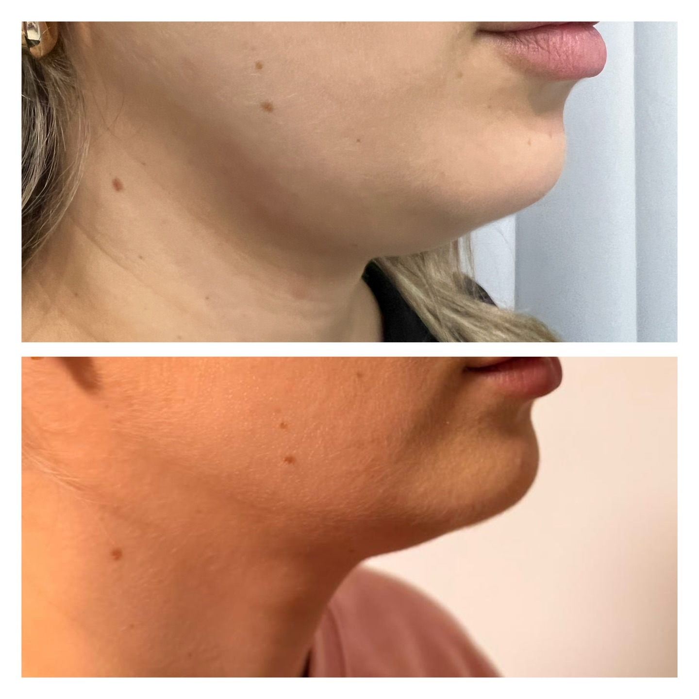 ✨ Doppelkinn adé – definierte Jawline in nur EINER Behandlung! ✨
Du wünschst dir eine straffe Kinnpartie und eine perfekte Jawline (Shoreline)? 😍
Mit der richtigen Behandlung kannst du gezielt Fettpolster reduzieren, die Haut straffen und dein Profil sichtbar verbessern – ganz ohne OP! 💉✨
✔️ Fett gezielt reduzieren
✔️ Haut sichtbar straffen
✔️ Konturen definieren
✔️ Sofort frischer & schlanker Look
💎 Doppelkinnreduktion nur 349 €
📩 Für mehr Infos oder Termine schreib mir gerne eine Nachrichat😘. #doppelkinn #fettreduktion #jawline #hamburg