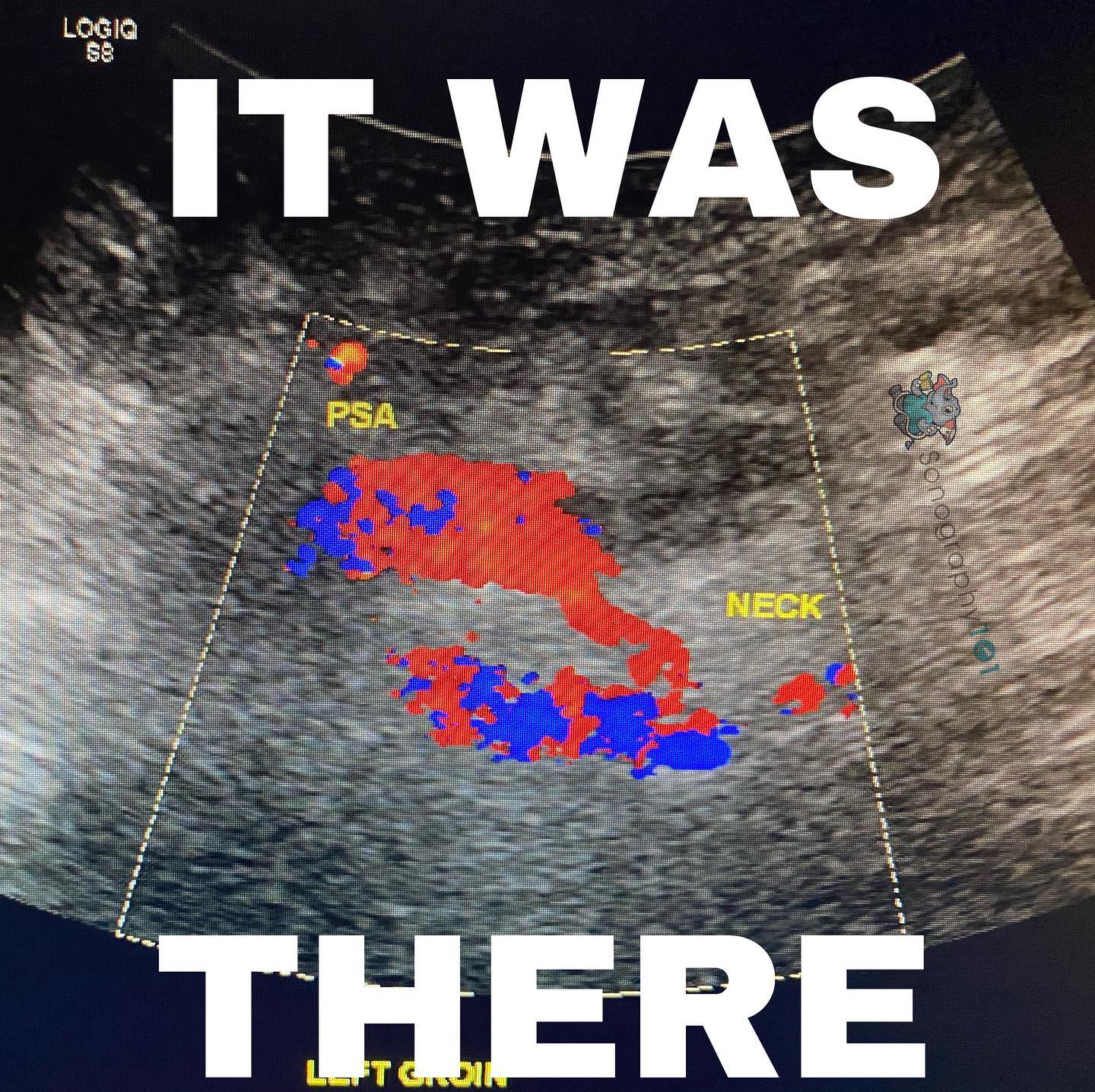 No need for a thrombin injection just get an ultrasound tech 😂 (Not the prettiest images but had to share 😅 with y’all, PSA rule outs can be tough 🥺, a lot of swelling & pain can make it sooo difficult for us)