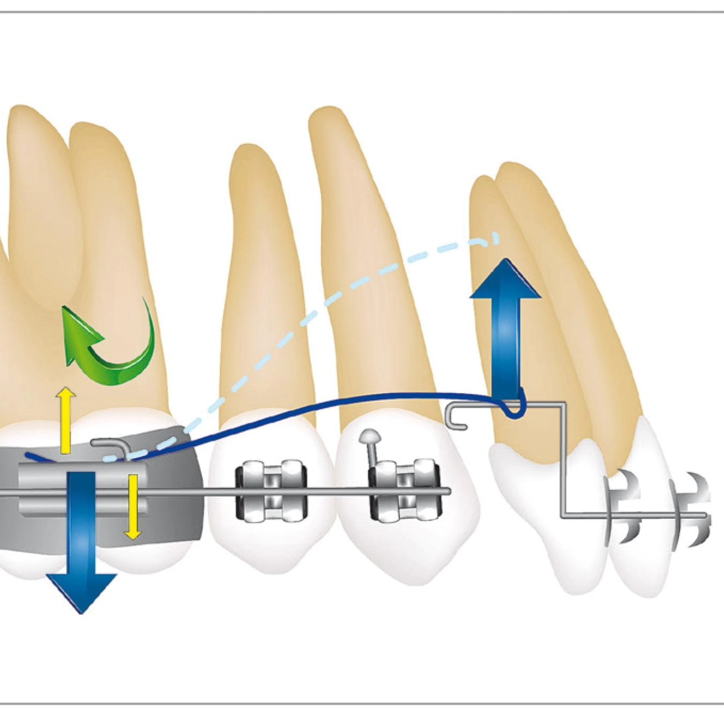 A happy Krishna Janmashtami to all.
The ongoing result in this case is like butter to Lord Krishna. 🤩🤩🥰🥰
Swipe right to see it
A type of segmented intrusion arch technique using SS wire for the correction of a deep bite.
#orthodontics
#stainlesssteel #intrusion #deepbite #biomechanics