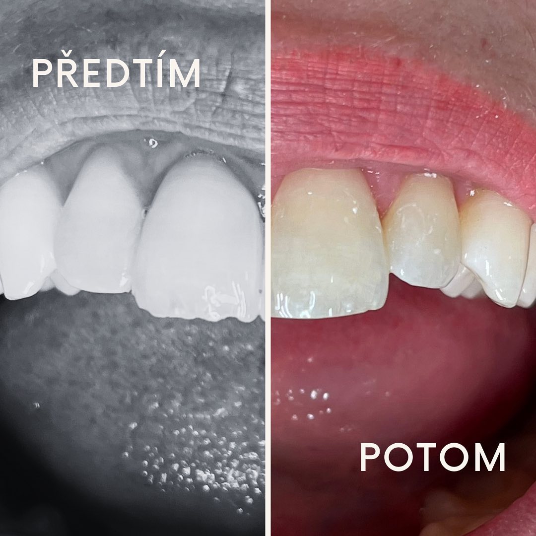 #dentalcare #dentalni #hygiena #prague #teeth #brousenizubu #dentalnihygiena