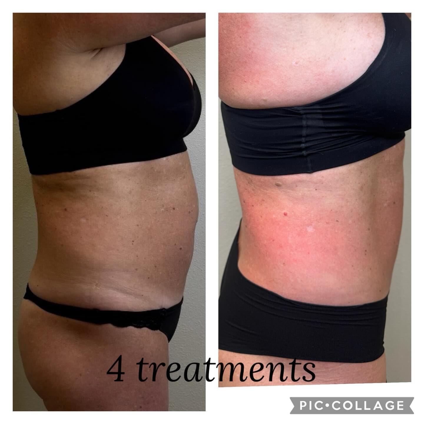✨ It’s T-shape Tuesday! This client saw amazing results in just 4 treatments with T-Shape 2! ✨
Say hello to a smoother, tighter midsection. This non-invasive body contouring treatment is designed to help you achieve your goals without surgery or downtime.
🍀 Body contouring
🍀 Cellulite reduction
🍀 Skin tightening
