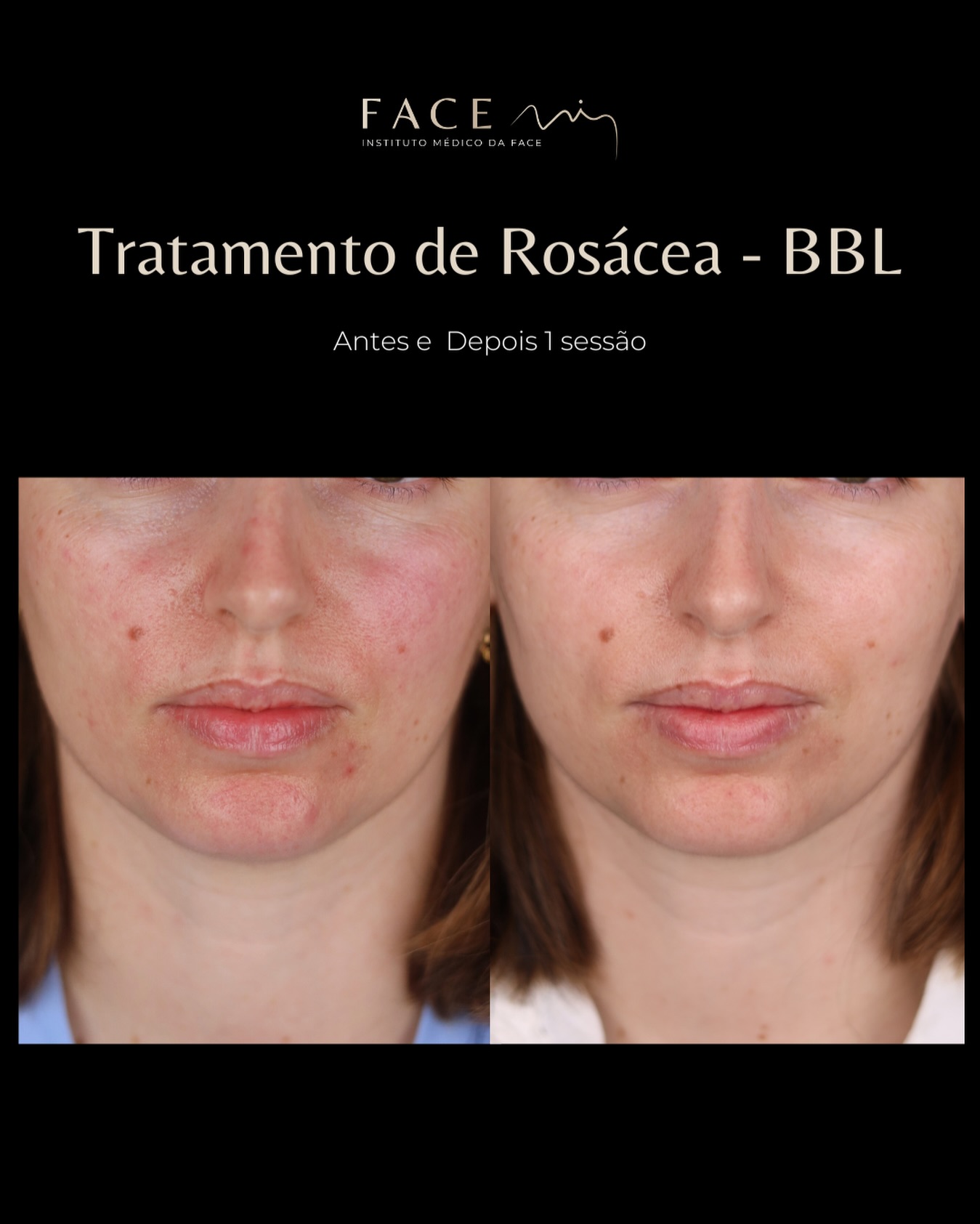 A rosácea não afeta apenas a pele. 🔴
Afeta a forma como a pessoa se vê — e como se sente.
Vermelhidão constante, sensibilidade, desconforto…
Para muitos pacientes, é algo diário.
Com o apoio de tecnologias como o BBL, conseguimos reduzir a inflamação, uniformizar o tom de pele e devolver conforto e confiança.
Não é apenas uma melhoria estética.
É qualidade de vida. 🟢
#bblheroic #rosacea #facemi #facemiporto #laserrosacea
Os casos clínicos apresentados refletem o antes e depois de pacientes específicos que deram o seu consentimento para serem apresentados nos canais e redes sociais do Instituto Face Mi.
Cada pessoa é única e o resultado pode variar de paciente para paciente. Todos os pacientes, antes de cada procedimento, passam por um processo de consulta médica de diagnóstico onde são avaliadas indicações, expectativas e motivações.
Instituto Médico da Face - Face Mi
Rua Prof Dr Carlos Lloyd 17, 4715-035
Braga Telef: 913553361
Registo ERS: 21236
Registo estabelecimento: E159774
Licença funcionamento: 21236/2022