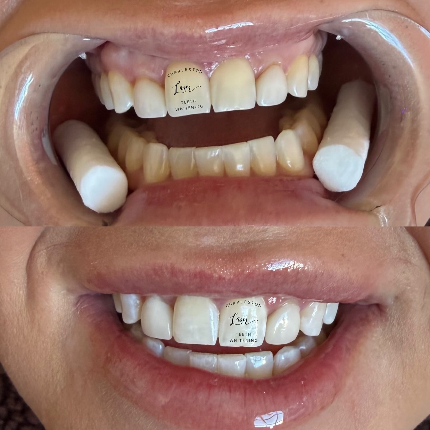 You can avoid colorful food and beverages to possibly prevent stains…Or you can just whiten your teeth.
☕️🌮🍷🌭🥃🍔🧋🤸♀️👩🏭🦷✨
#teethwhitening #charlestonteethwhitening #charleston #charlestonsc #charlestonlaserteethwhitening mountpleasant mountpleasantsc kiawahisland kiawahjamesisland westashley isleofpalms downtowncharleston sullivansisland johnsisland johnsisland northcharleston northcharlestonsc folly follybeach laserteethwhitening