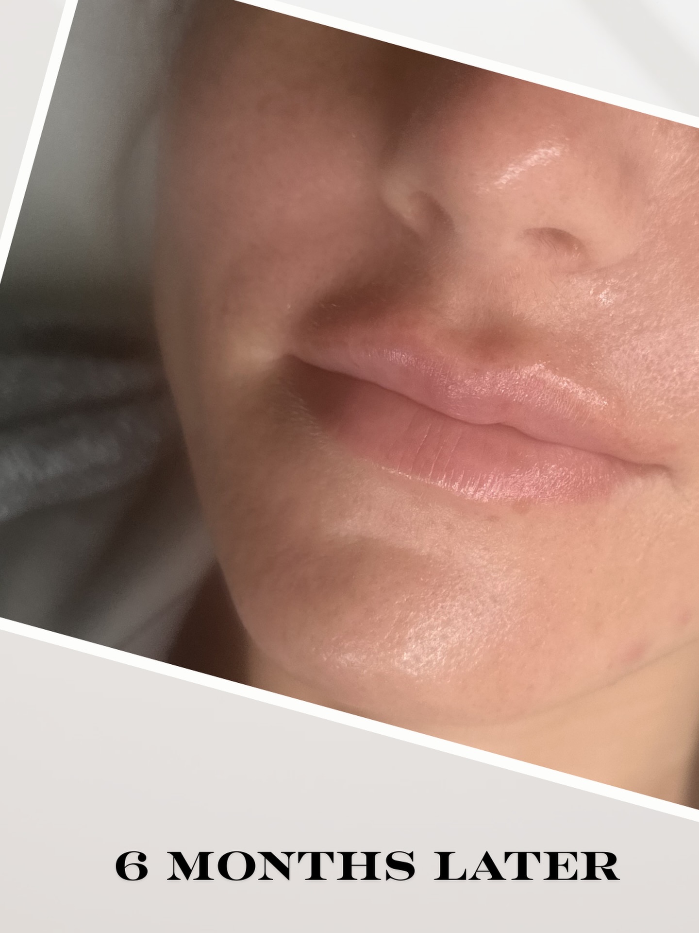 6 months later… 💋
Still soft, still plump, still beautifully natural ✨
That’s the power of subtle enhancement and proper maintenance 💄
📲 Ready for your refresh? Book via our website
📱 Text 914-496-2298