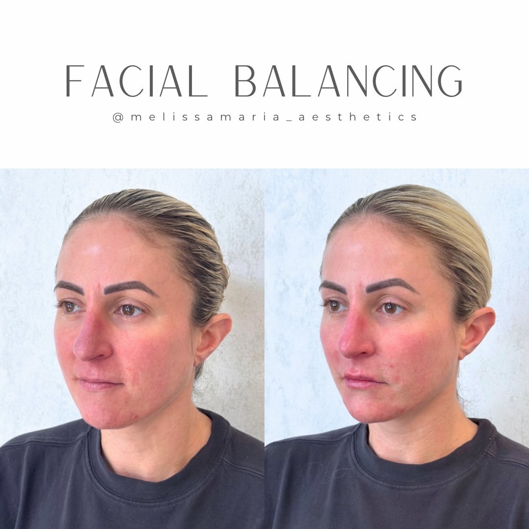 Facial balancing for the win!! What a subtle but huge difference! Here we added some contour while softening her shadows and adding some balance to her profile!
Can you tell what treatments were done?
#facialbalancing #facialbalancingraleigh #facialbalancinggreensboro #facialbalancingcharlotte