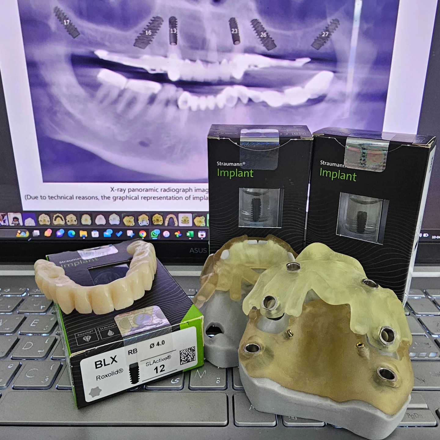 What you seek is seeking you!
Guided implant placement followed by immediate loading.
Precise, Pleasant and Aesthetic Dentistry ❤️🤩
#straumann #blx #guided #guidedsurgery #cadcam #3dprinting #additivemanufacturing #allonx #fullmouthrehabilitation #fullnouthreconstruction