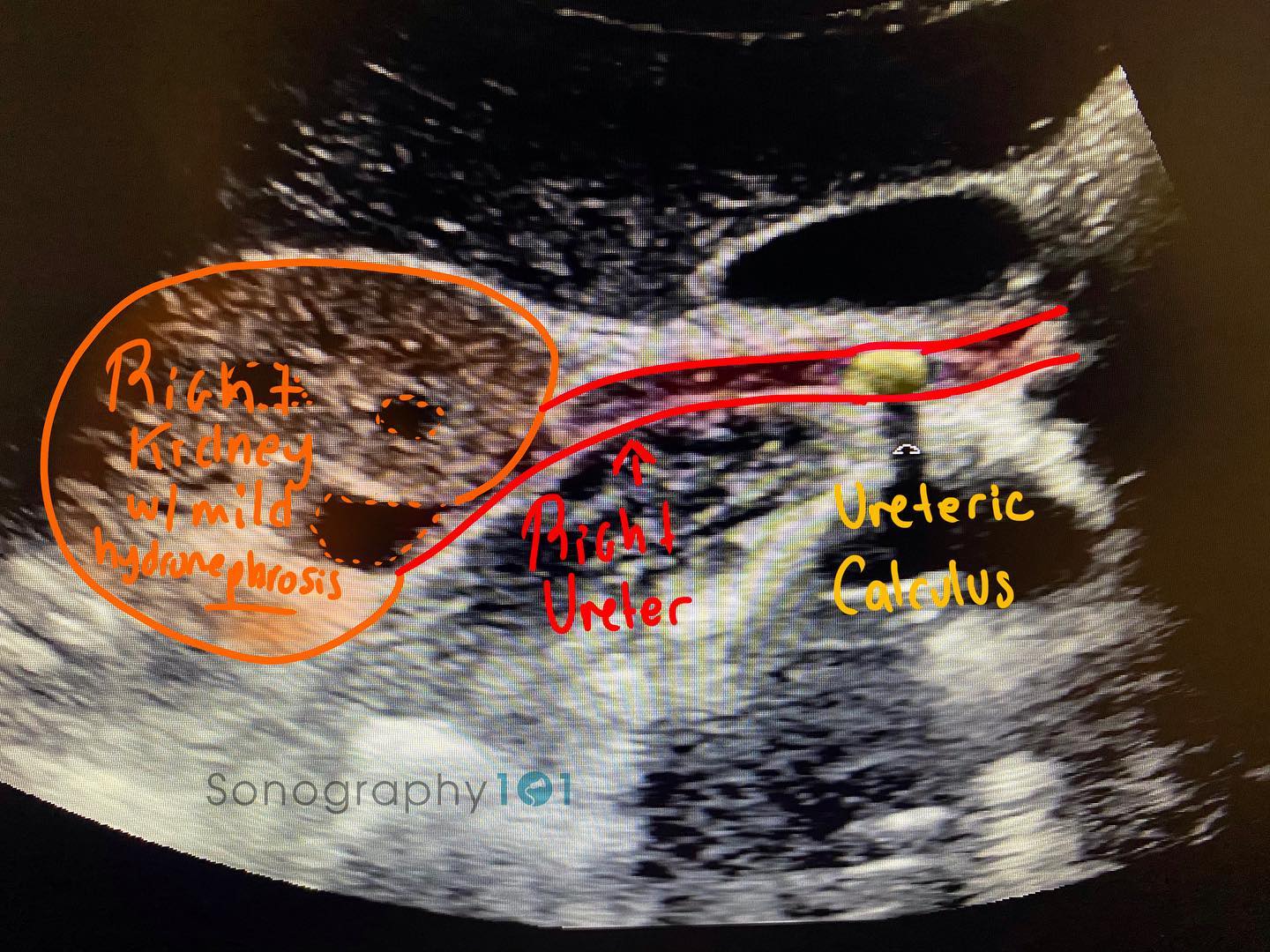 Right sided mild hydronephrosis secondary to a ureteric calculus.
*one of our last WWW. As I’ve mentioned before one of the best ways to learn something is drawing it out 🤗
.
.
.
.
#ultrasound #sonography #medicalsonography #RDMS #RVT #RegisteredDiagnosticMedicalSonographer #RegisteredVascularTechnologist #UltrasoundTechnologist #Sonographer #UltrasoundTech #Sonography101 #ultrasoundED #ultrasononography #ultrasonographer #Medicine #Medical #Radiology #Radiologia #Ultrasonido #DiagnosticImaging #Medicina #Sonograma
#sonographystudent #sonographyschool