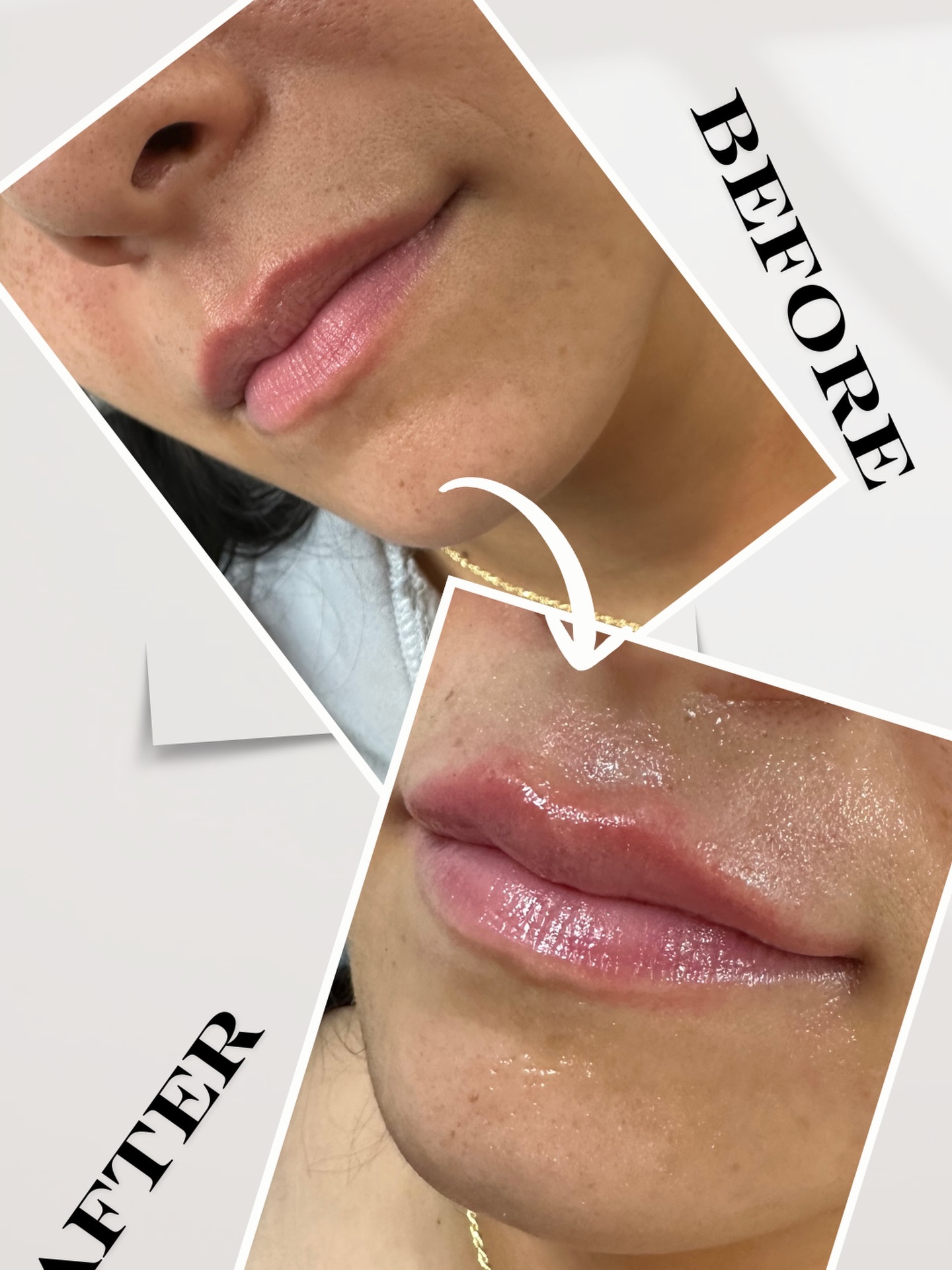 Do you just want a little symmetry? We got you 💋
Enhance your natural beauty with subtle, balanced results—because perfection doesn’t have to look overdone ✨
📲 Book your appointment via our website: www.luxemedicalinc.com
📱 Or text 914-496-2298
Natural. Refined. YOU.