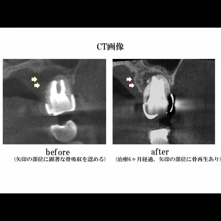 éªšãæº¶ããŠããŠããæ¯ã¯æ®ããå¯èœæ§ããããŸãã
ðž 1æç®ïŒè¡åã®CTç»åïŒèµ€ãç¢å°ã®éšåã®éªšã溶ããŠããŸãïŒ
ðž 2æç®ïŒæ²»çããå幎åŸã骚ãèŠäºã«åçããŠããŠããŸãâš
溶ãã骚ãå®å
šã«åçããã®ã«ã¯ã1幎以äžããããããåŒãç¶ãçµéã芳å¯ããŠãããŸãïŒ
æ²»çã®éµã¯ãèçŒã§ã¯èŠããªã现éšãŸã§æããããã€ã¯ãã¹ã³ãŒãããšãäžçåºæºã®ãç±³åœåŒæ¯å
çæ³ãã®çµã¿åããã
åœé¢ã®é¢é·ã¯ã埳島ã§ãæ°å°ãªãæ¥æ¬é¡åŸ®é¡æ¯ç§åŠäŒèªå®å»ã§ãããããã³ã倧åŠç±³åœåŒæ¯å
çæ³ãä¿®äºããŠããŸãã
ãäžæ¬ã®æ¯ã倧åã«ãããã
ãã®æ³ãã«ãæå
ç«¯ã®æè¡ã§å¯ãæ·»ããŸãã
詳现ãªçäŸè§£èª¬ã¯ãããã£ãŒã«æ¬ã®ãªã³ã¯ããðŠ·
å€§èŒæ¯ãæææ ¹ç®¡æ²»çã165,000åïŒçšèŸŒïŒ
#åŸ³å³¶åžæ¯å»è
#ãã€ã¯ãã¹ã³ãŒãæ¯ç§æ²»ç #æ ¹ã®æ²»ç #ä¿åæ²»ç #ææ¯åé¿ #æ¯ç§CT #åççæ³ #æ¯å
çæ³ #ã²ããæ¯ç§