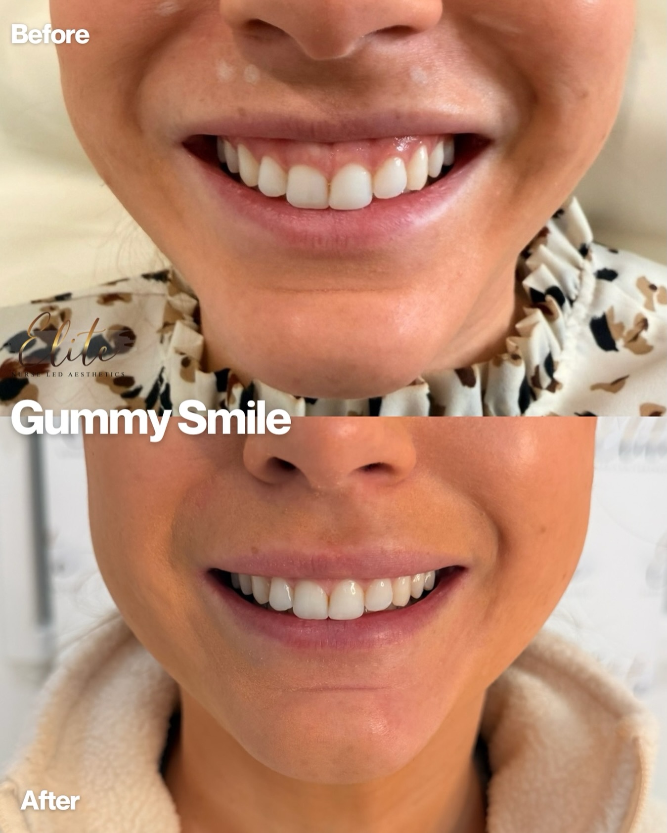 Gummy Smile Transformation ✨
Ever feel like your smile shows more gum than teeth? You’re not alone—and the good news is it’s easily treatable. 💉
Before ➡️ After:
This subtle treatment relaxes the muscles that lift the upper lip too high, allowing your smile to sit more naturally and reveal more of your teeth rather than excess gum.
Benefits:
✔️ Creates a more balanced, natural-looking smile
✔️ Quick, non-surgical treatment
✔️ Minimal downtime
✔️ Results visible within days
✔️ Boosts confidence when smiling and laughing
At Elite Nurse Led Aesthetics, we focus on natural, confidence-boosting results tailored to you. ✨
📍 Wakefield
📩 Message us to book your consultation or send us a DM to find out if gummy smile treatment is right for you.
#WakefieldAesthetics #GummySmileTreatment #EliteNurseLedAesthetics #NaturalAesthetics #ConfidenceInYourSmile