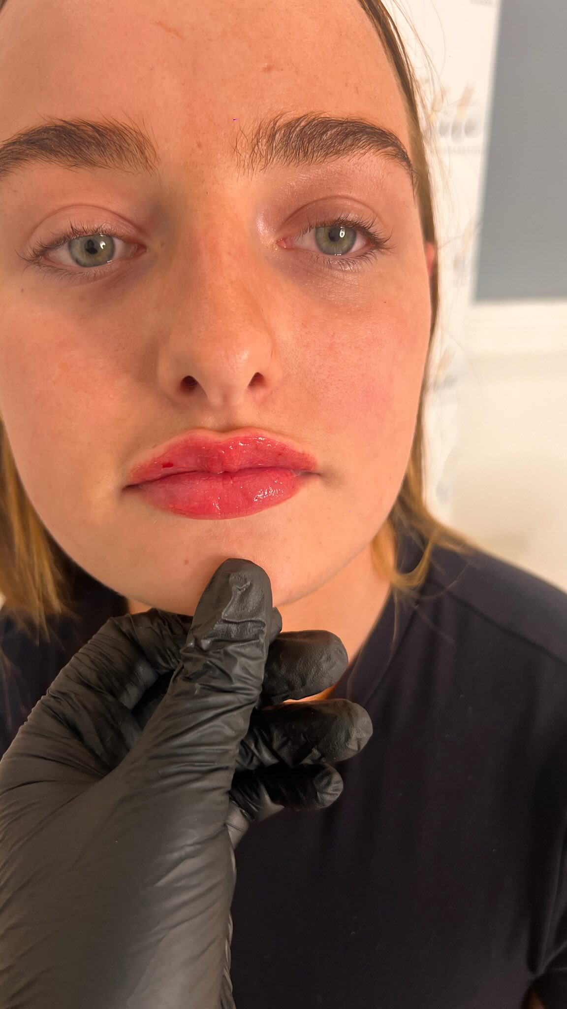 Lip Filler – Tailored to You 💋
Not all lips should look the same… because your lips are uniquely yours. ✨
At Elite Nurse Led Aesthetics, we believe lip filler isn’t about copying trends or creating the same look for everyone. Every set of lips has its own natural shape, proportions, and movement — which is why each treatment is carefully tailored to enhance your unique features.
Benefits of a Bespoke Lip Treatment:
✔️ Enhances your natural lip shape
✔️ Restores volume and definition
✔️ Improves symmetry and balance
✔️ Hydrates and smooths the lips
✔️ Natural-looking, personalised results
Our goal is always to create balanced, beautiful lips that complement your face — never a “one size fits all” result. 💉✨
📍 Wakefield
📩 Message us to book your consultation and let’s create the perfect lip shape for you.
#LipFillerWakefield #EliteNurseLedAesthetics #NaturalLipFiller #WakefieldAesthetics #LipEnhancement