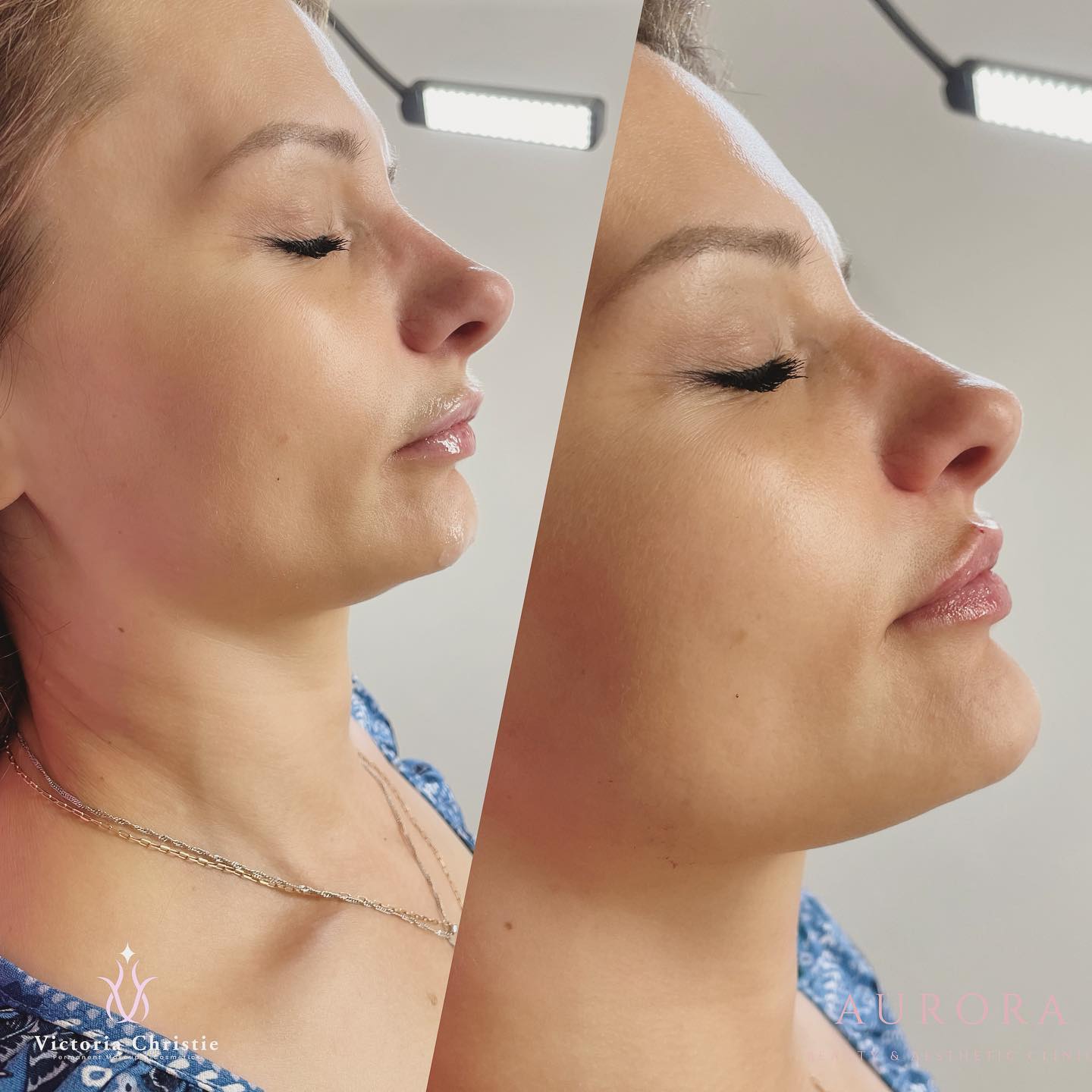 Chin and lip fillers 🪄
Improving profile with fillers can be subtle but transformational 💕
www.AuroraAesthetic.co.uk