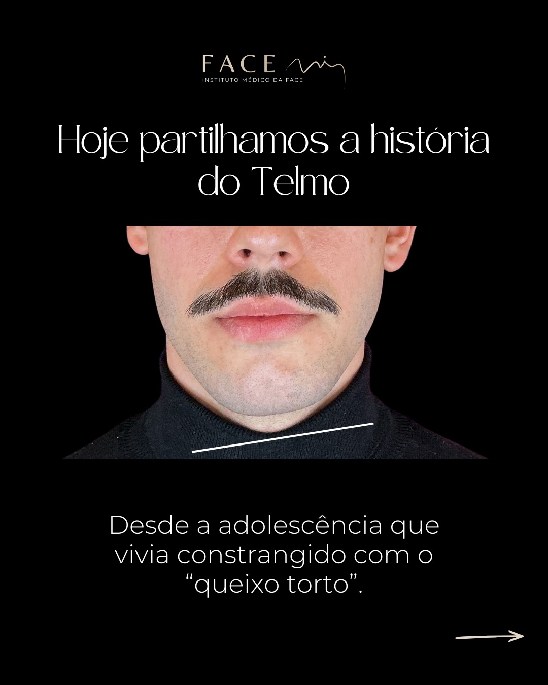 Nem sempre a Harmonização facial é sobre Estética, a maioria das vezes é sobre auto-estima e reconhecer-se quando olhamos ao espelho.
O preenchimento com ácido hialurónico tem a capacidade de corrigir assimetrias faciais com rigor e segurança médica.
A história do Telmo inspira-nos todos os dias para melhorarmos a vida de cada um dos nossos pacientes que confia em nós.
Obrigado pela confiança ⭐️⭐️⭐️⭐️⭐️
Os casos clínicos apresentados refletem o antes e depois de pacientes específicos. Cada pessoa é única e o resultado pode variar de paciente para paciente.
Todos os pacientes, antes de cada procedimento, passam por um processo de consulta médica de diagnóstico onde são avaliadas indicações, expectativas e motivações.
Registo ERS: 21236
Registo estabelecimento: E159774
Licença funcionamento: 21236/2022
