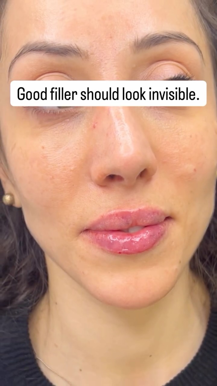 Filler isn’t the problem☝🏼💉
Bad technique and too much product are‼️
The goal should always be natural, balanced results🫠👩🏼⚕️ #natural #filler #fullface #rejuvenation
📌Save this if you’re thinking about filler