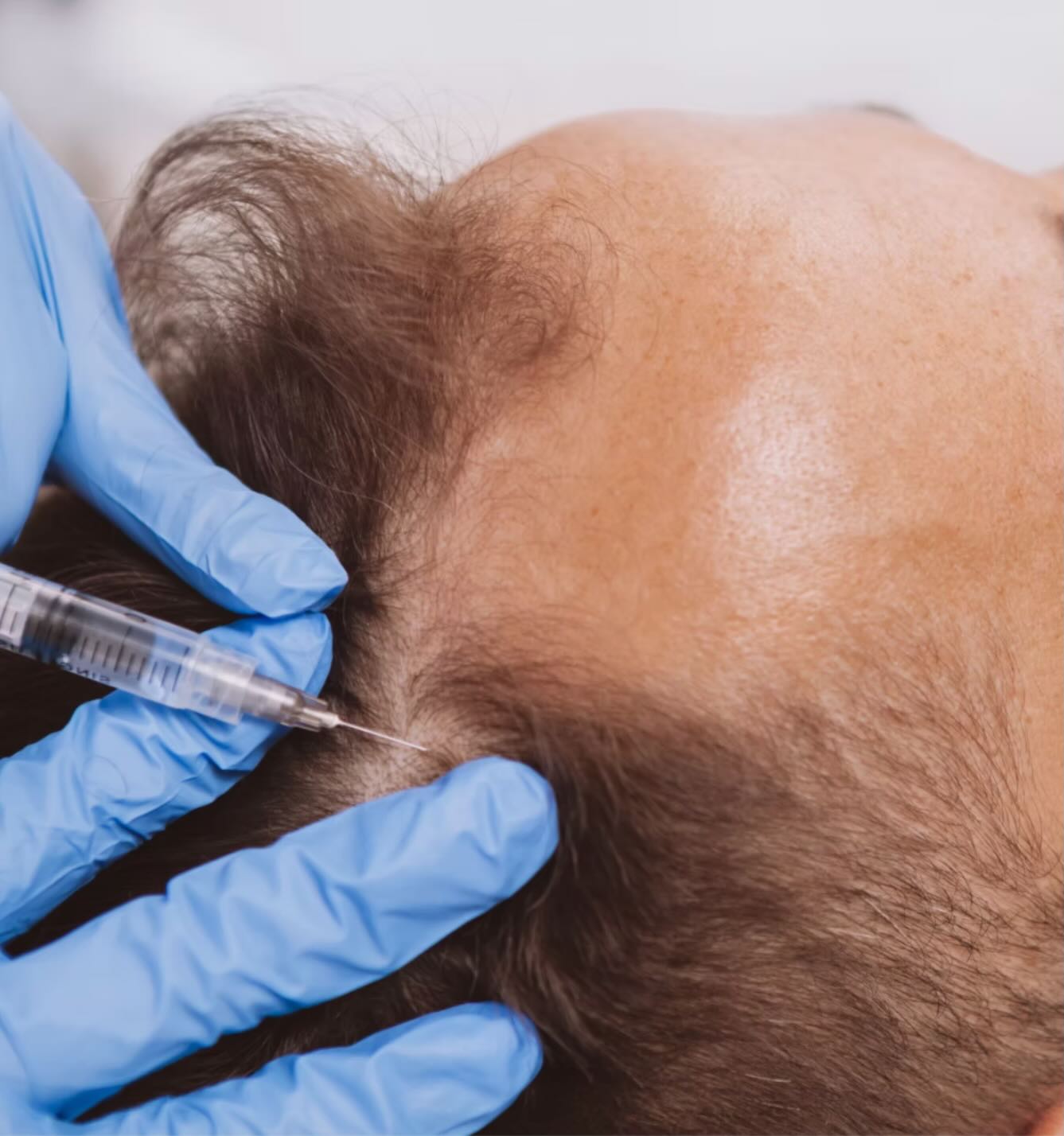 ⨠Hair Loss Sampler Package â¨
PRP ⢠Microneedling ⢠Biotin Boost ⢠LED Therapy
Struggling with thinning hair or shedding? Our advanced multi-therapy treatment helps stimulate follicles, strengthen hair, and support natural regrowth â without surgery.
Perfect for:â¨â˘ Thinning hairâ¨â˘ Postpartum sheddingâ¨â˘ Hormonal hair lossâ¨â˘ Early pattern hair loss
Stronger. Healthier. Fuller-looking hair starts here.
đ Consultation required.
#hairrestoration #hairlosshelp #prphair #microneedling #hairgrowth