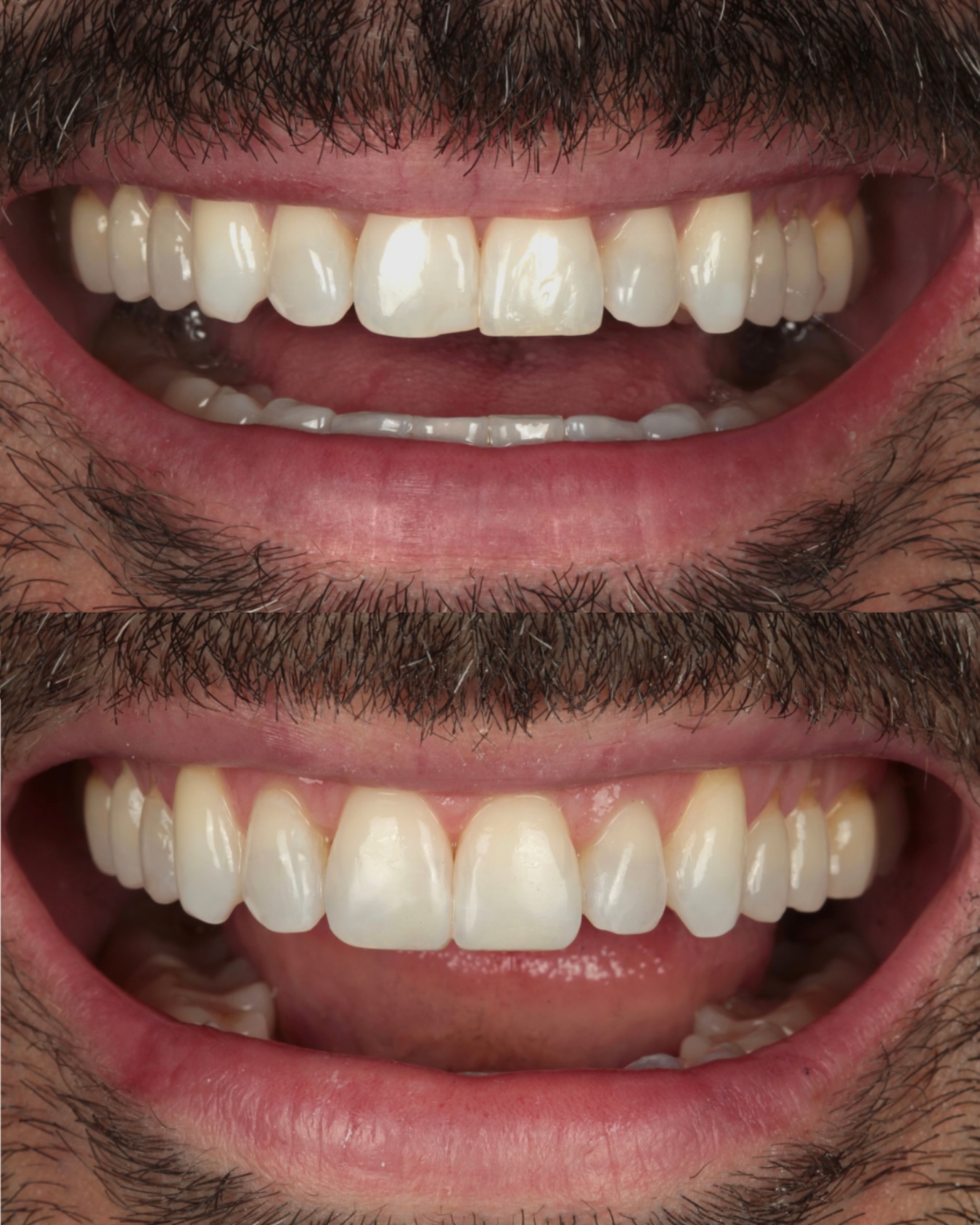 Você consegue apontar o que mudou? 🔎
Nós adoramos quando o resultado é exatamente este: você olha o “depois”, percebe que o sorriso está muito mais harmônico e bonito, mas não sabe dizer exatamente onde foi mexido.
Isso acontece quando a naturalidade guia o tratamento. Neste caso, realizamos apenas um cuidadoso acréscimo de resina nos dois incisivos centrais (dois dentes da frente).
Um detalhe sutil que devolveu o equilíbrio estético de forma super discreta, respeitando os traços originais.
Beleza de verdade é aquela que parece que sempre esteve ali!
Clínica PATO: Há 50 anos transformando sorrisos e cuidando de famílias.