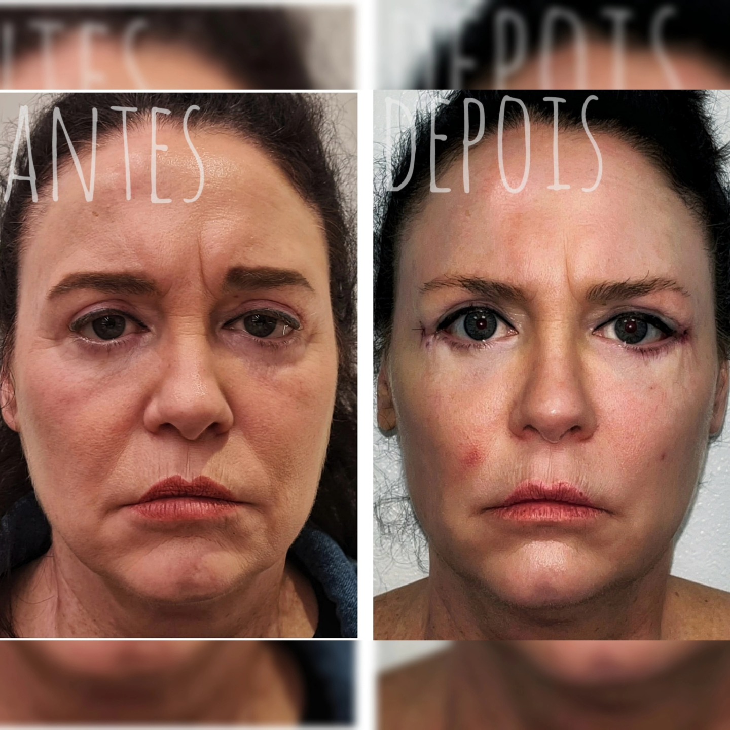👉 Caso de Blefaroplastia de Revisão
Esta paciente procurou-nos após ter realizado uma blefaroplastia superior e inferior por via transconjuntival com outro cirurgião. Embora satisfeita com a parte superior, sentia que o resultado da blefaroplastia inferior não correspondia às suas expectativas.
Após uma avaliação cuidada da face e das suas queixas, propusemos uma blefaroplastia inferior subciliar de revisão, permitindo um melhor reposicionamento dos tecidos. Aproveitámos a mesma incisão para realizar um facelift do terço médio da face, promovendo um rejuvenescimento mais harmonioso e natural.
O resultado? Uma transição mais suave entre pálpebra e face, olhar mais descansado e uma expressão visivelmente mais leve.
📸 Deslize para ver o antes e depois.
O que acha da transformação?
#Blefaroplastia #CirurgiaPlásticaFacial #Facelift #RejuvenescimentoFacial #CirurgiaEstética #AntesEDepois