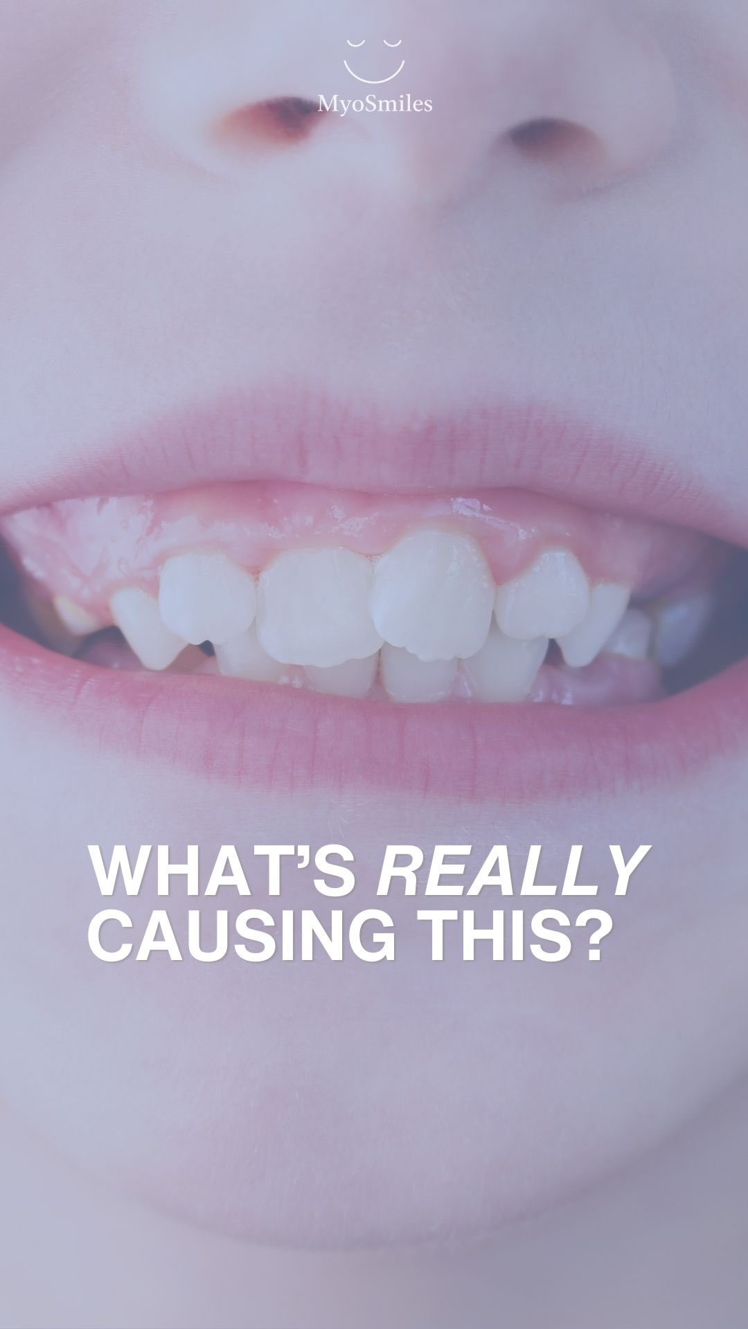 Crooked teeth are often just the symptom…not the root cause!
When a child’s smile is developing, the real question isn’t only how to straighten teeth… it’s why they became misaligned in the first place.
At MyoSmiles, Dr. Ingrid focuses on early intervention through myofunctional therapy — supporting proper breathing, jaw development, and oral habits while your child is still growing.
If you’ve noticed crowding, mouth breathing, or habits like thumb sucking, it may be time to look deeper.
✨ Book a consultation to learn how we can support your child’s development from the inside out.
.
.
.
early orthodontics | myofunctional therapy | airway health | pediatric dentistry | crooked teeth causes | jaw development | mouth breathing | kids oral health | preventive orthodontics | myosmiles #oralhealth #myofunctionaltherapy #pediatricdentist #mouthbreathing #children