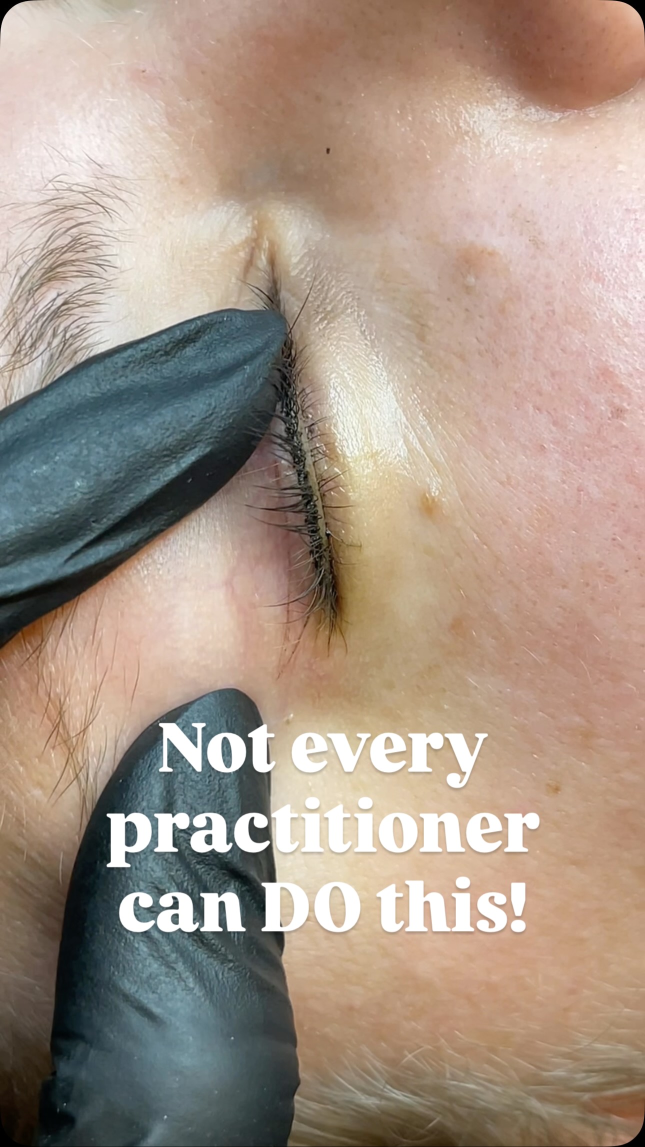 Permanent eyeliner can feel intimidating for many clients, and one of the most common questions I hear is: “How do I know it will look the way I want?”
Before the procedure begins, we carefully design and map the eyeliner together. Once you approve the shape and thickness, I begin by precisely outlining the eyeliner with the needle and pigment.
This outline becomes the blueprint for the entire procedure and ensures symmetry, balance, and the exact style we agreed on.
Creating a clean, controlled outline with the machine is actually one of the most technically challenging parts of the eyeliner procedure, and it takes years of training, practice, and advanced technique to execute it correctly.
Once the outline is perfected, the rest of the work follows that guide to create a soft, balanced eyeliner that enhances your natural eye shape.
✨ What you’re seeing here is the actual pigment outline created with the needle — the foundation of the final result.
#pmureels #beautyreels #bostonreels #massachusettsreels #explorepage #reelsinstagram #reelsviral #reelsbeauty #pmutransformation #beforeandafterbeauty #pmuartist #permanentmakeup #permanenteyeliner #lashenhancement #eyelinertattoo #cosmetictattoo #naturalpmu #softenhancement #wakeupwithmakeup #effortlessbeauty #bostonpmu #permanentmakeupma #needhamma #westwoodma #eastonma #bostonbeauty #newenglandbeauty #pmuboston #bostonclients #supportlocalma