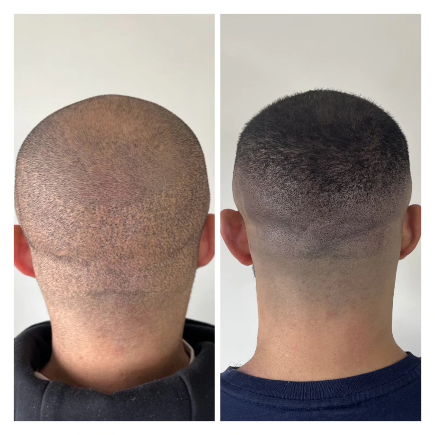 SCAR CAMOUFLAGE
FUE hair transplant scar camouflage using Scalp micro-pigmentation (SMP)
Cosmetic tattooing to the highest standard
📍Suffolk & Brighton Studios
@kwadron_pmu machine
@ghostpigment pigment
@killerbeautypmu consumables
#scar #scartreatment
#scarcamouflagetattoo #scarcamouflage #scarcoverup #scarcoveruptattoo #fue #transplantscar #hairtransplant #fuescar #transplantscar #cosmetictattoo #hair tattoo