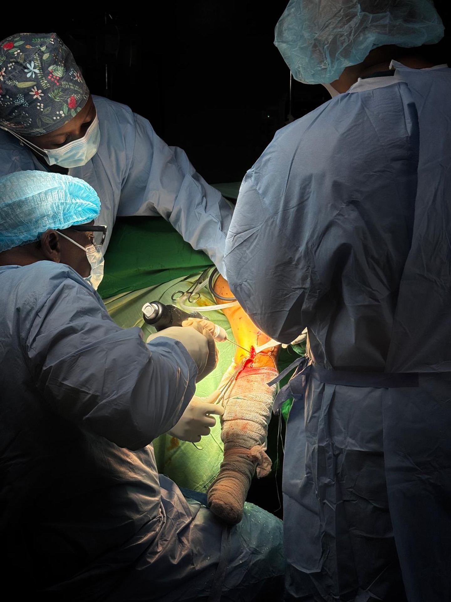 🩺 Precision in Action – Restoring Movement, Rebuilding Lives
In the operating room in Georgetown, Guyana, our H.E.R.O.
Surgery Team is performing advanced procedures including microfracture and ACL repair—helping patients regain mobility, reduce pain, and return to their daily lives.
These aren’t just surgeries—they are second chances.
Each procedure restores function, strengthens stability, and brings hope to patients who have been living with injury and limited movement.
From careful precision to compassionate care, our team is working tirelessly to make every moment count.
💙 Restoring movement. Rebuilding lives. This is H.E.R.O. in action.
#HEROMission2026 #SurgeryInAction #ACLRepair #Microfracture #GeorgetownGuyana MedicalMission HEROCares OrthopedicCare ChangingLives