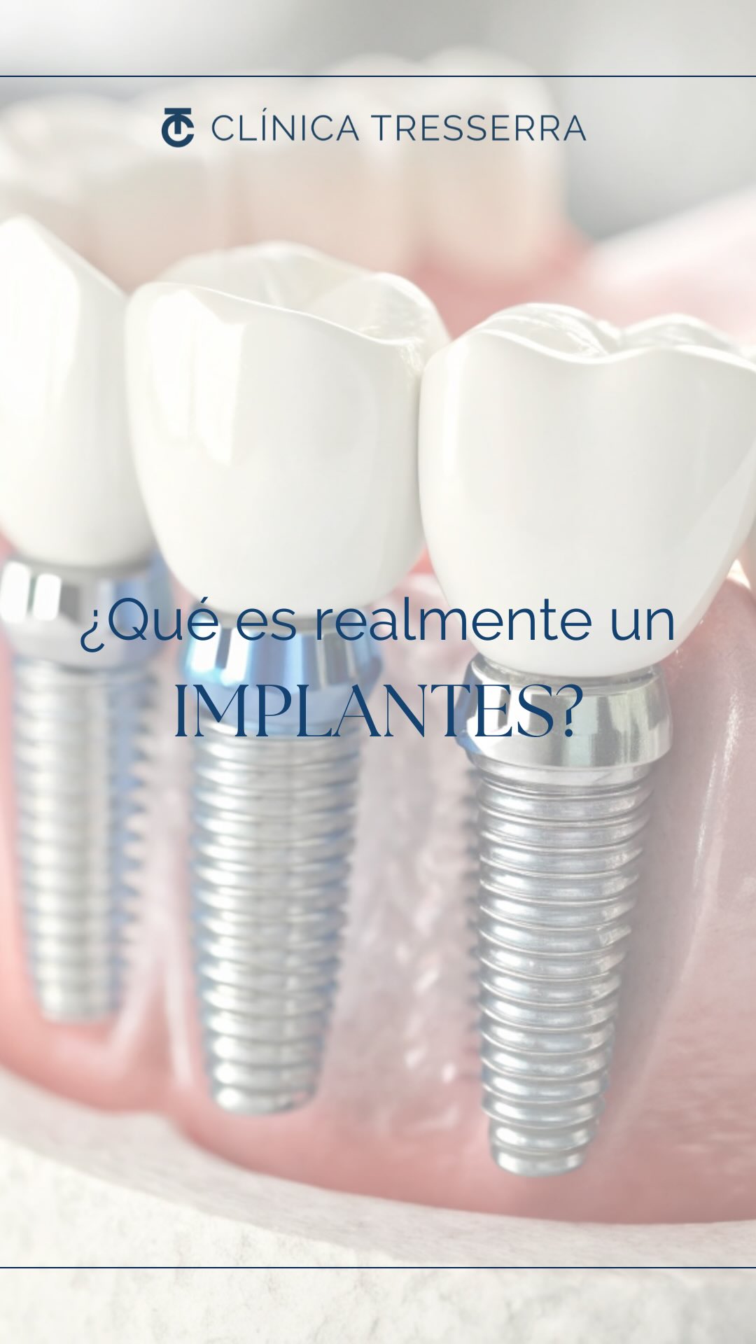 La Dra. Ana Tresserra lo explica de forma sencilla:
✨ Un implante es una raíz artificial que se coloca en el hueso para sustituir un diente perdido y devolver función, estética y estabilidad a tu sonrisa.
Es la opción más parecida a un diente natural.
Y, bien cuidado, puede acompañarte durante muchos años.
💬 ¿Tenías claro qué era un implante antes de ver este reel?
📩 Envía este vídeo a alguien que esté valorando ponerse uno.
#ImplantesDentales #implante #ClínicaTresserra #SaludBucal #DentistaBarcelona