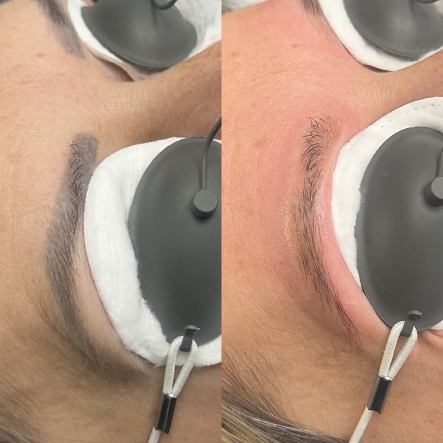 Before & After Laser Brow Removal 🪄