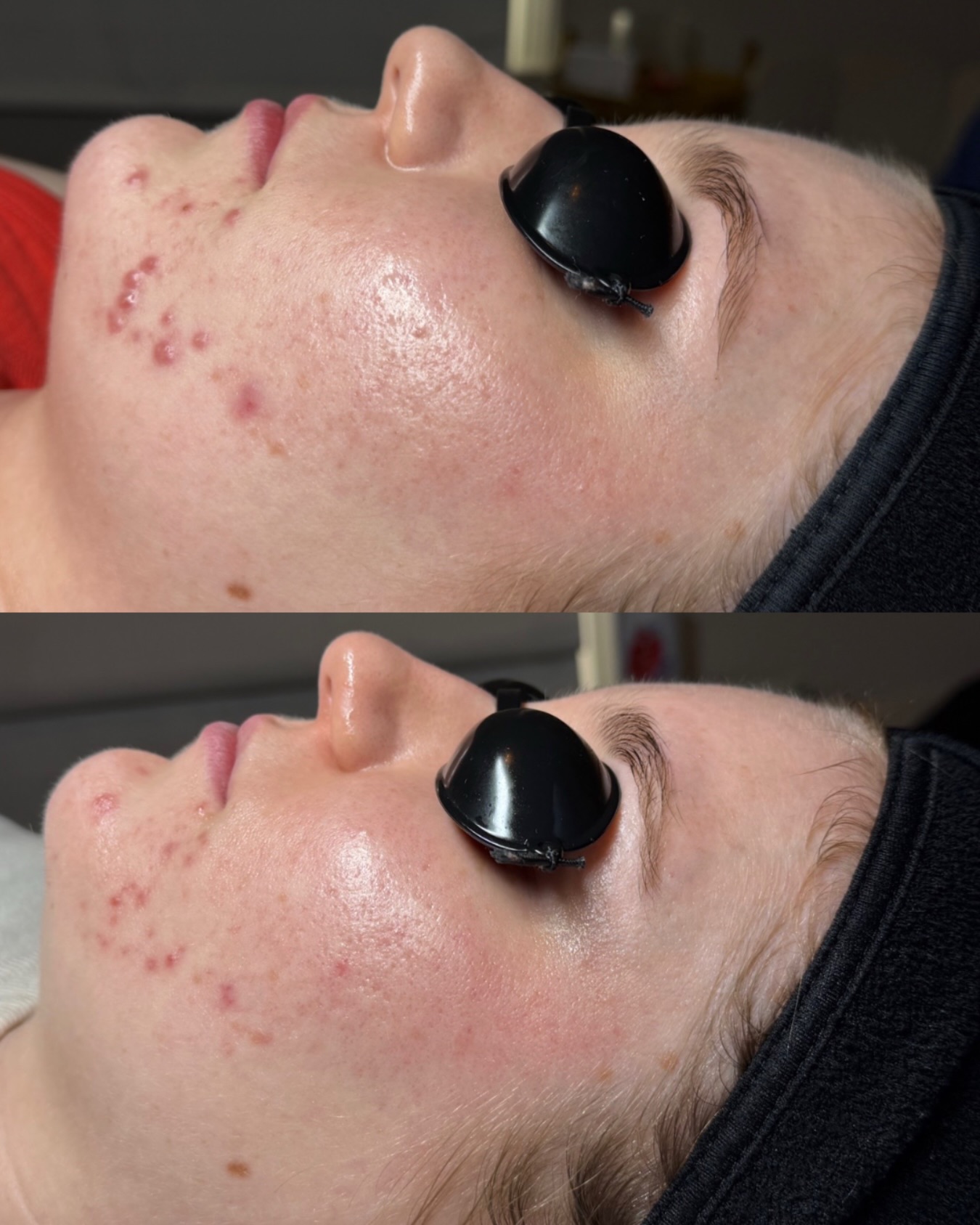 30 days, 2 treatments, and a customized home care regimen curated by @aestheticsbyilyana 🙌🏼🙌🏼🙌🏼