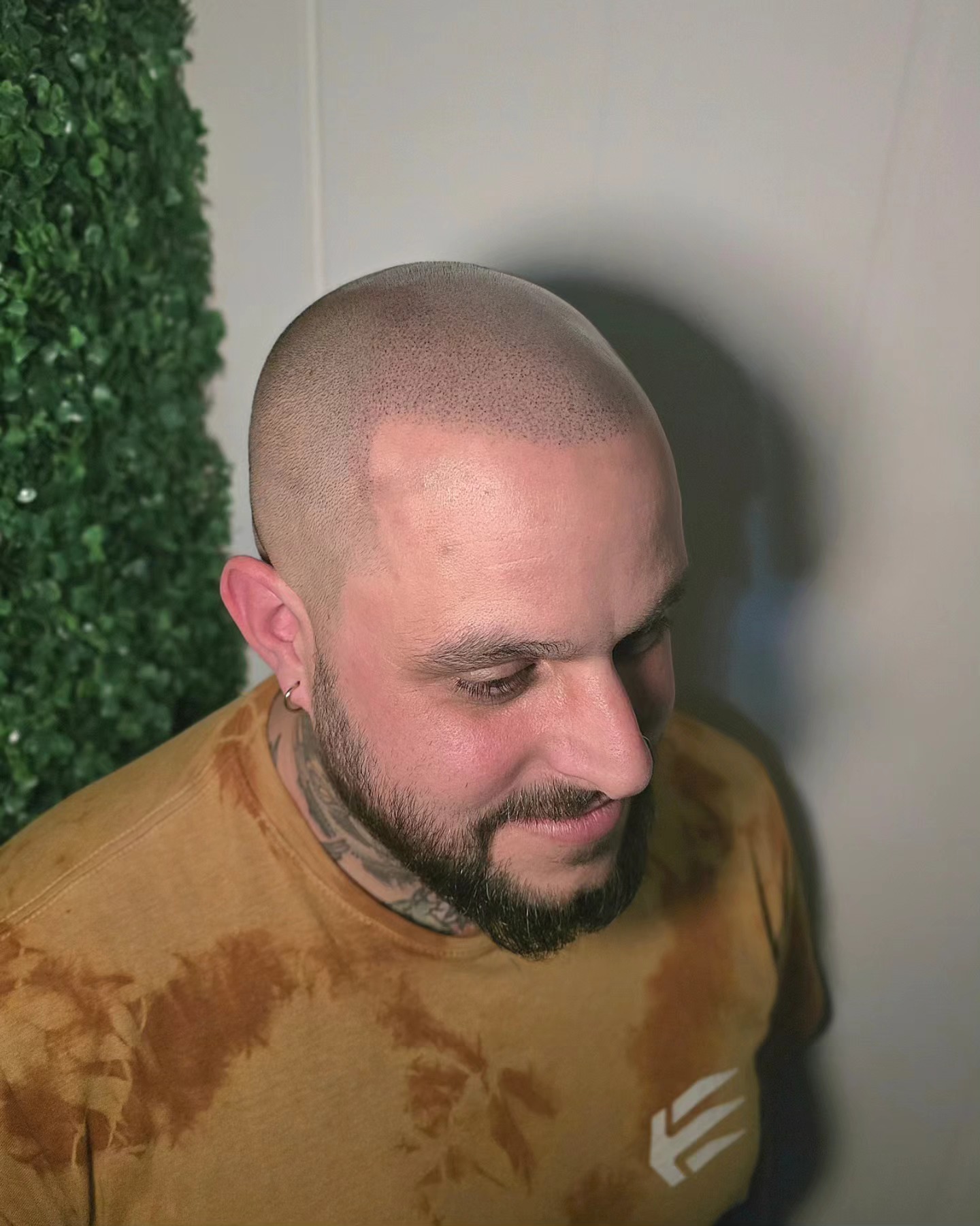 SCALP MICRO-PIGMENTATION
This is not real hair! Hair tattoo at its finest!
- Guaranteed results
- Non invasive treatment
- Minimal to low maintenance
- No medication or surgery
- Applicable at any stage or hair loss
- Natural looking, hyper realistic results
- Pain rating varies between clients but most describe as mildly uncomfortable
📍Bury St Edmunds, Suffolk
#hairtattoo #hair #menshair #buzzcut #smp #scalptreatment #scalpmicropigmentation ##scalppigmentation #hairloss #hairregrowthtreatment #hairlife #hairgrowth #hairregrowthtreatment #hairreplacement #hairregrowth #hairtransformation #hairtrends #hairlosssolution #newhair #shave #hairfall #balding #recedinghairline #receding #bald #barber #tattooartist #cosmetictattoo