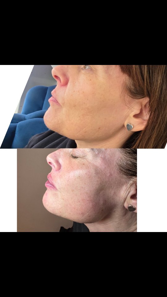 🚀 POV: You fix facial balance instead of chasing trends 👀
No overfilling.
No frozen look.
Just strategic rebalancing 💉
✨ 5ml full face
✨ Tox-free upper face
✨ Skin boosters for that glow loading…
And yes… under £400 👏
Would you try this? 👇
Check out hmbsalon.co.uk
WhatsApp 07572 336447
#POVBeauty #AestheticTok #GlowUpJourney #SubtleWork #FacialBalance BeforeAfter SkinGoals UKAesthetics FillerResults