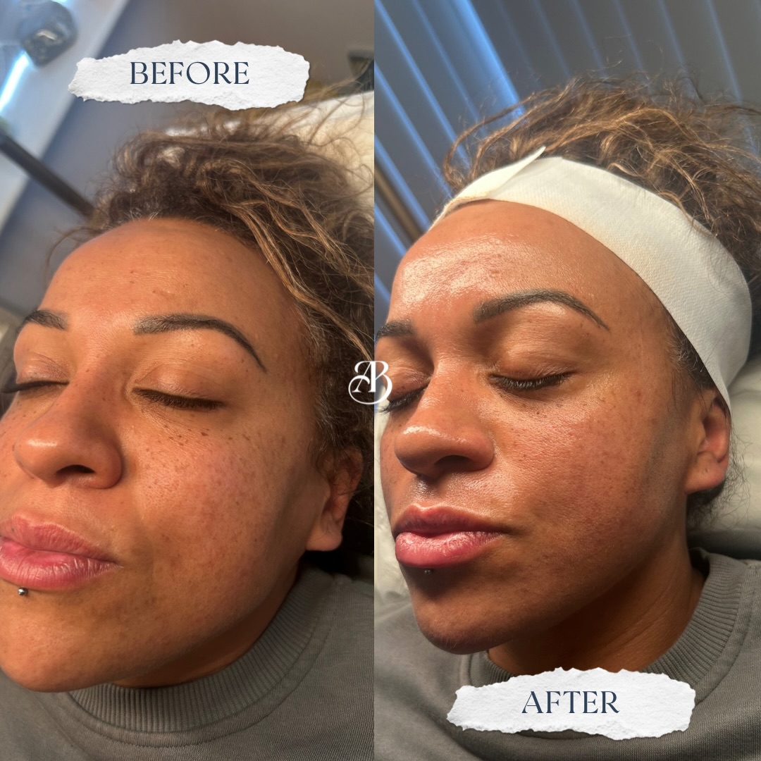 Is your skin glowing… or just surviving? ✨
There is nothing better than that post treatment glow! Fresh skin, refined texture and confidence.
Investing in your skin is always worth it 🤍
DM us today to book in your consultation!
📍Oldswinford, Stourbridge
#aesthetics #skin #skinrejuvenation #dermaplaning #glow