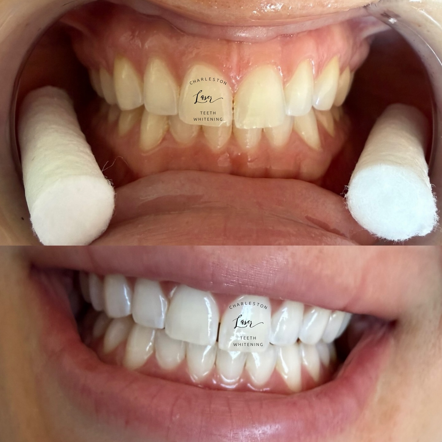 Are you Ken & Barbie Party ready? 11am to 12am @saltcowboys 💗
Book your teeth whitening now!
www.CharlestonLaserTeethWhitening.com
#teethwhitening #charlestonteethwhitening #charleston #charlestonsc #charlestonlaserteethwhitening mountpleasant mountpleasantsc kiawahisland kiawahjamesisland westashley isleofpalms downtowncharleston sullivansisland johnsisland johnsisland northcharleston northcharlestonsc folly follybeach laserteethwhitening